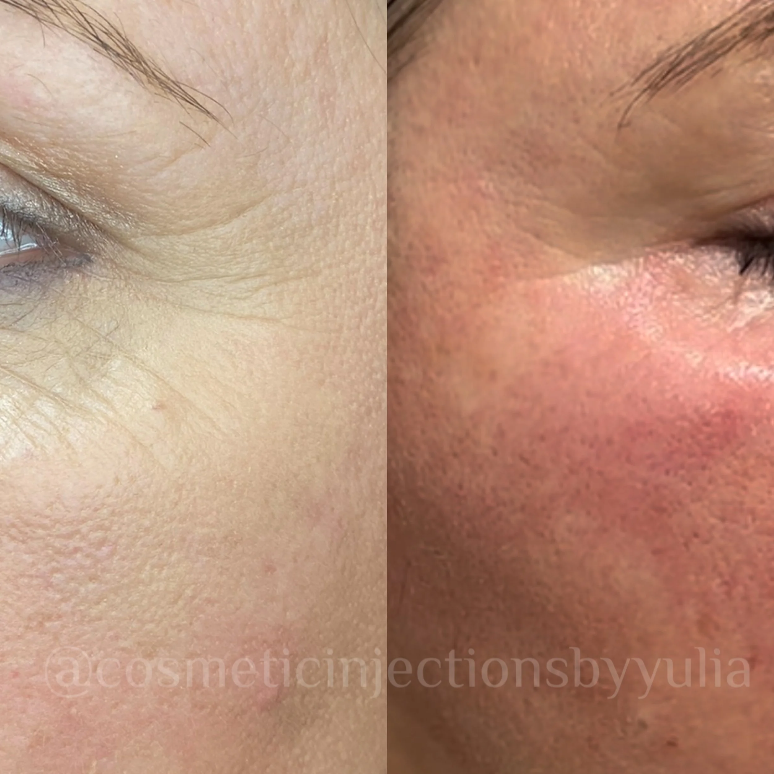 Immediatley after 1 PRX Treatment