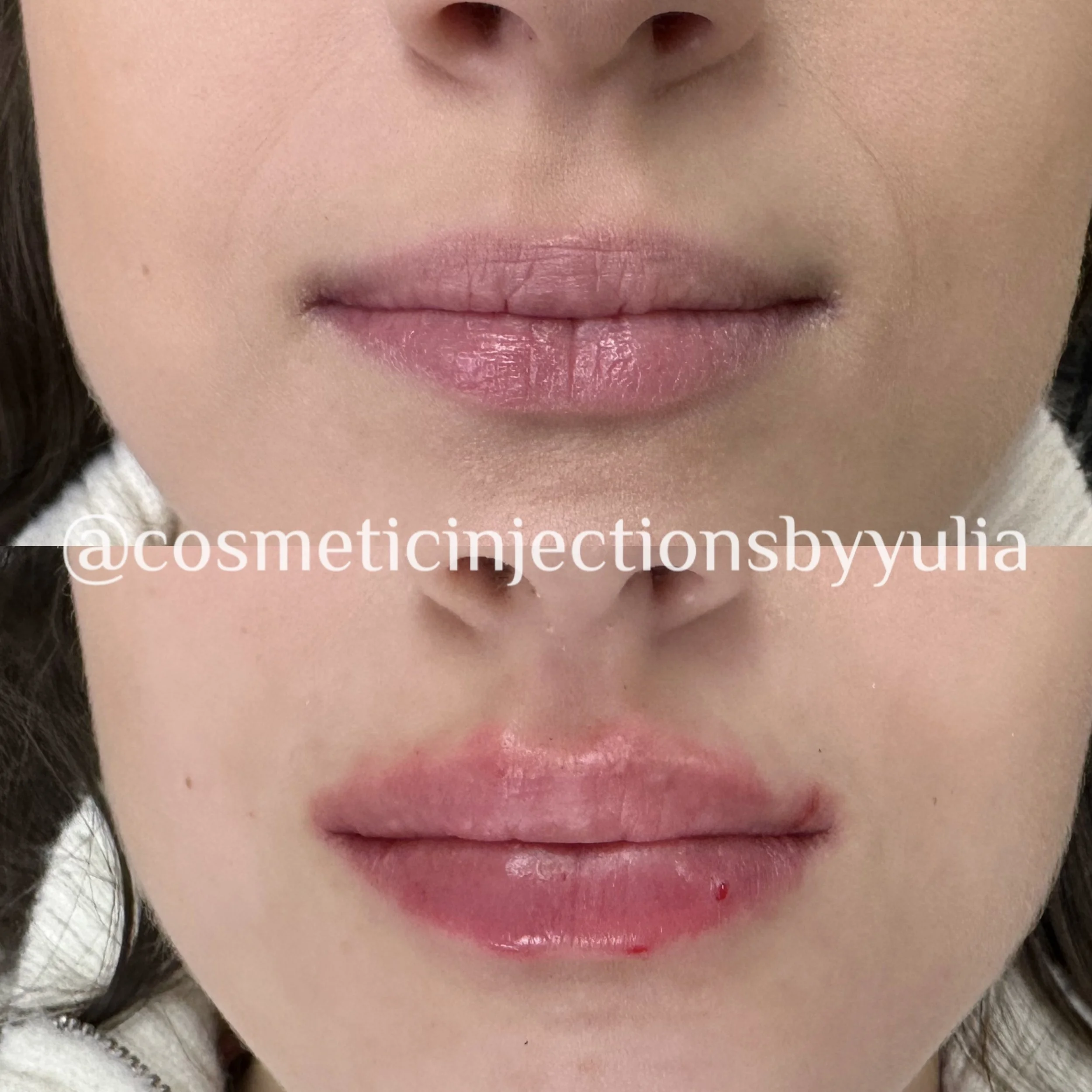 Results shown immediately after treatment. Please note that there is swelling.