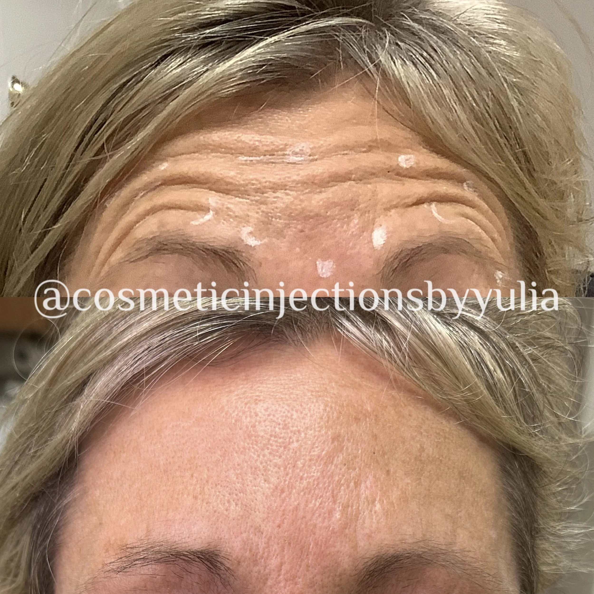 Botox treatment of forehead lines