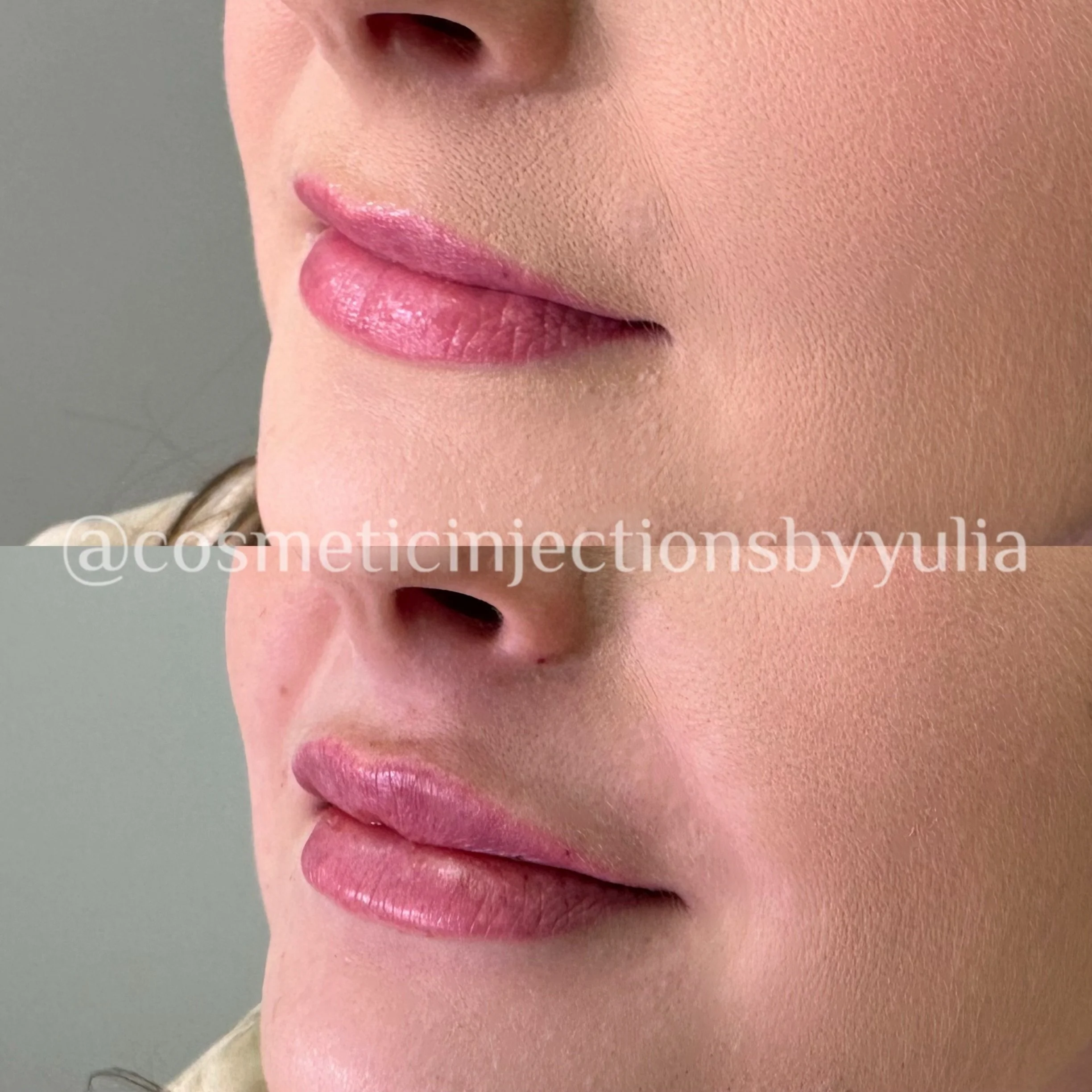 Immediately after treatment. Please note that there is swelling.