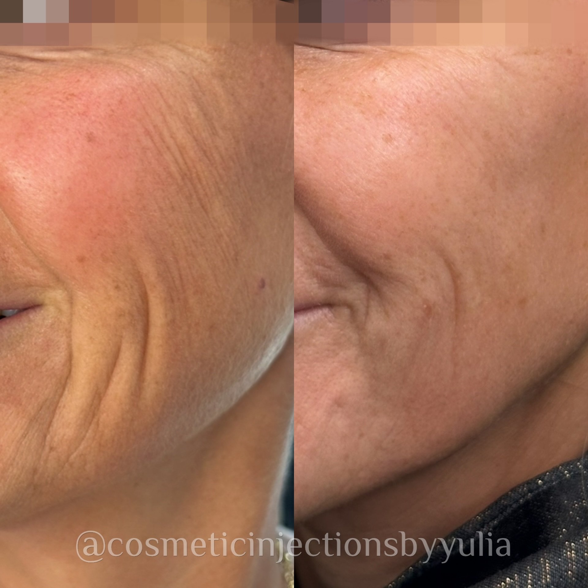 2 weeks after dermal filler support to smile lines. This treatment specifically reinforces the skin to promote collagen building in the wrinkle fold.