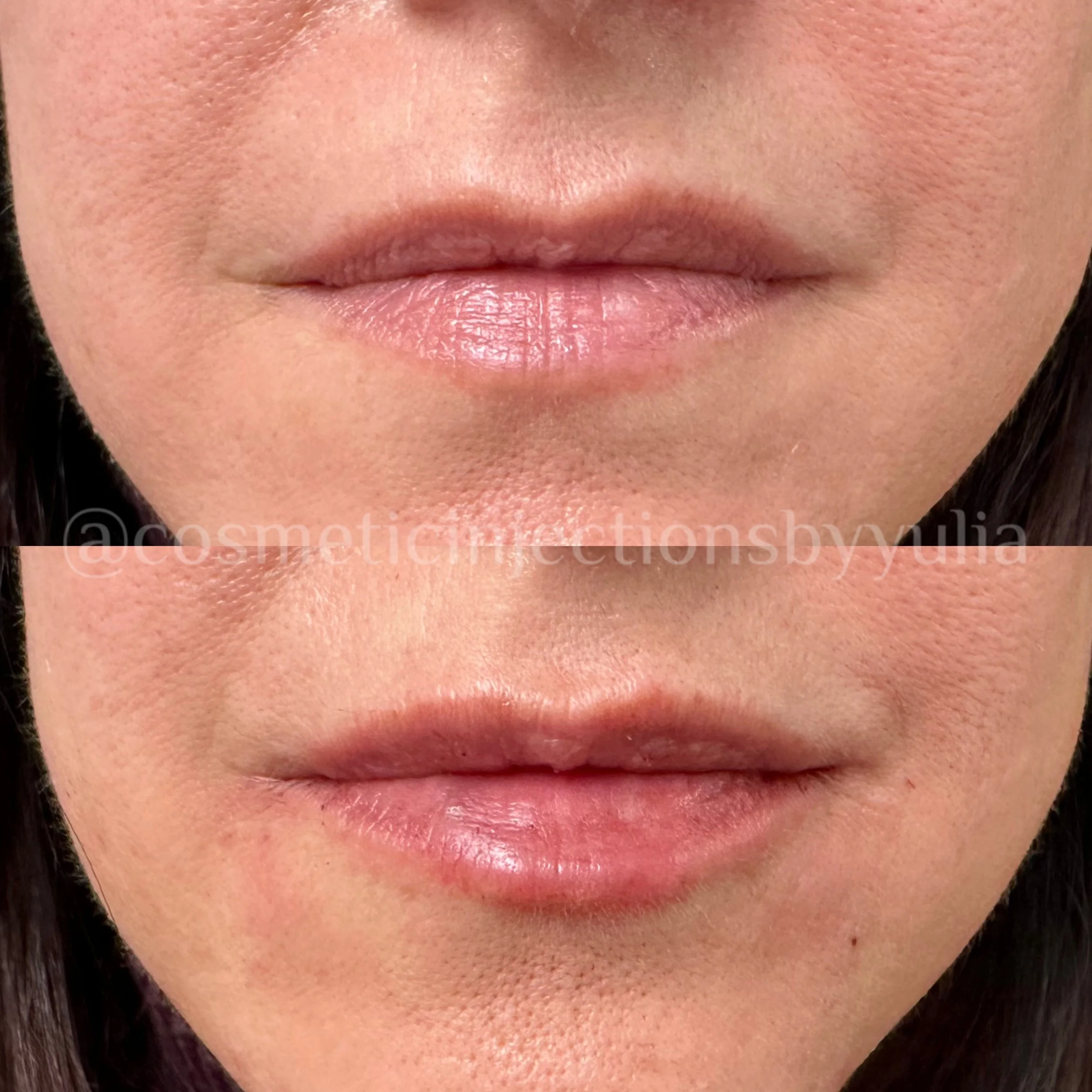 Filler for lip hydration.