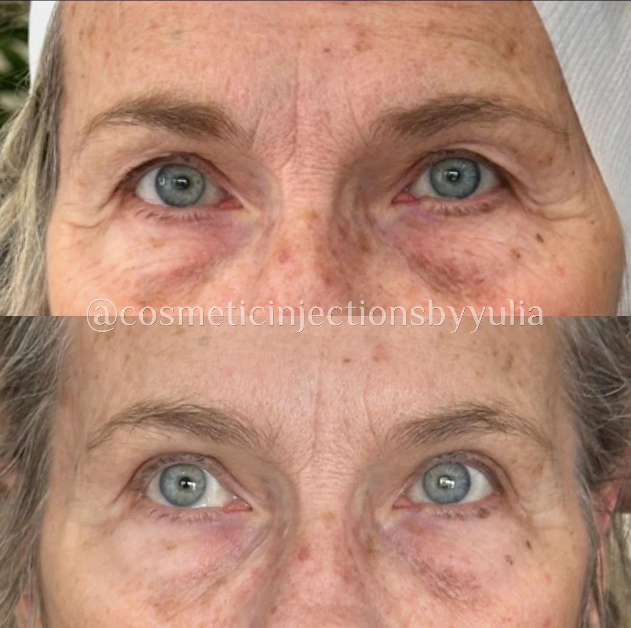 After a series of 4 PRX treatments
