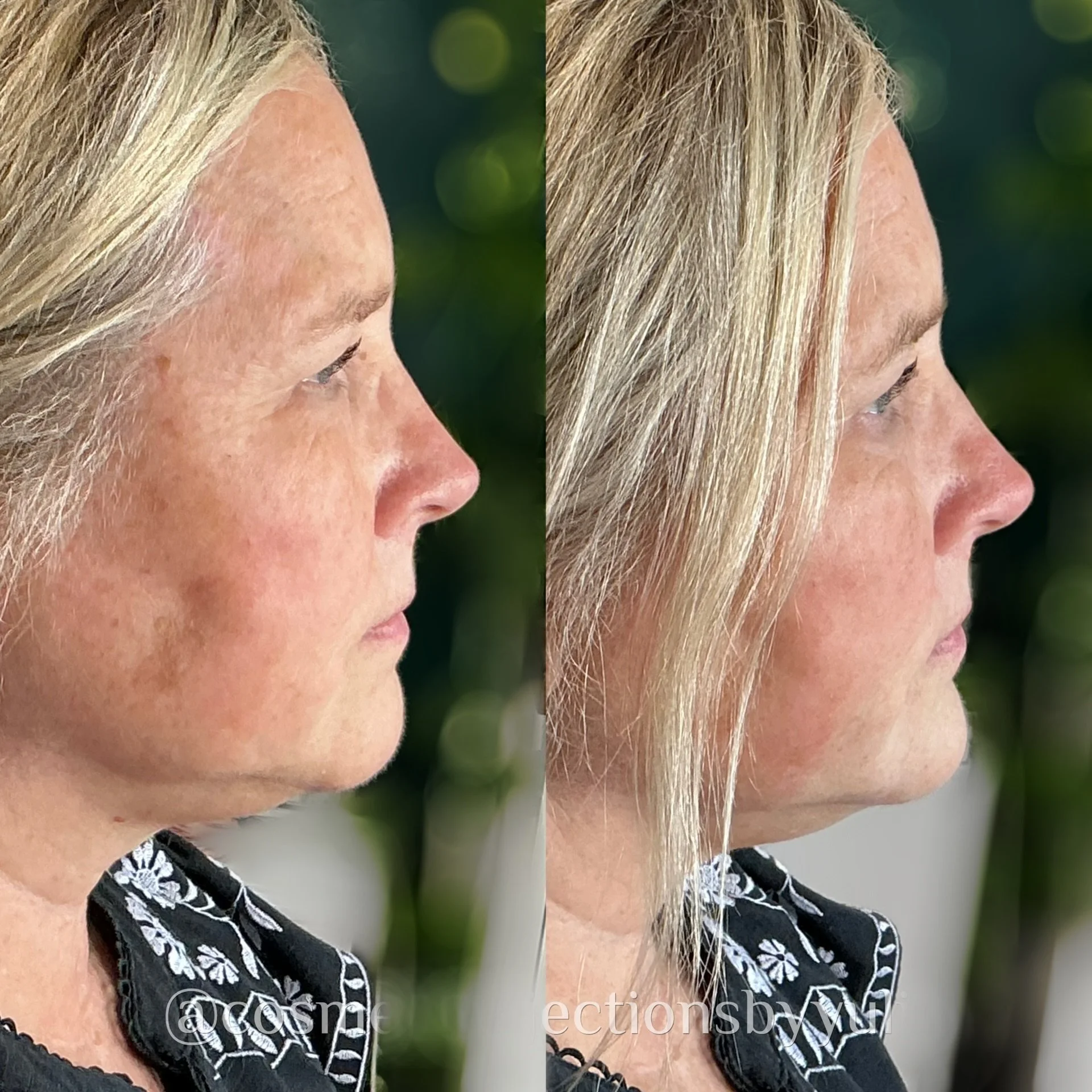 Filler to her chin and jawline for marionette line softening and balancing out facial proportions