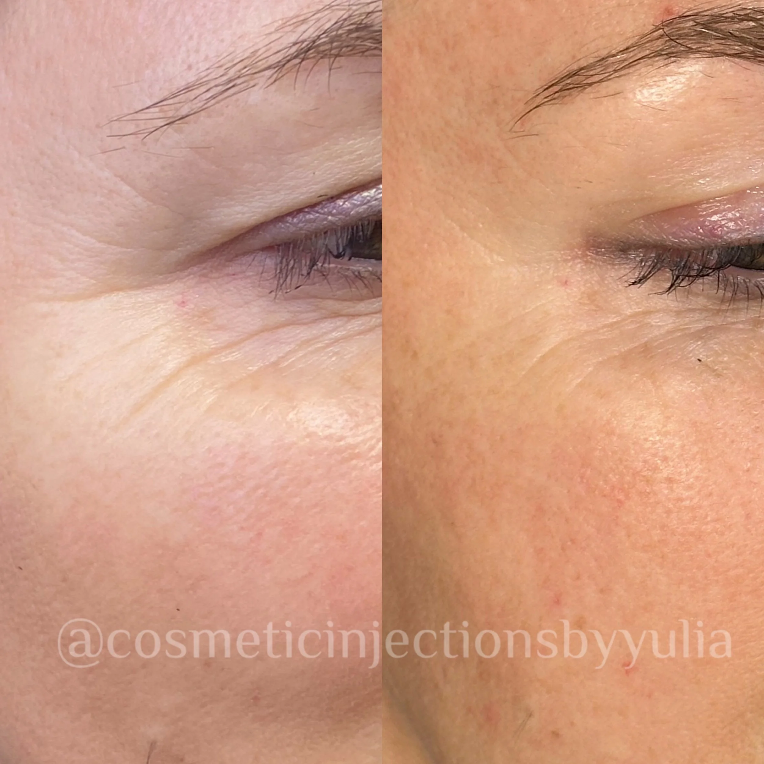 Immediatley after 1 PRX Treatment