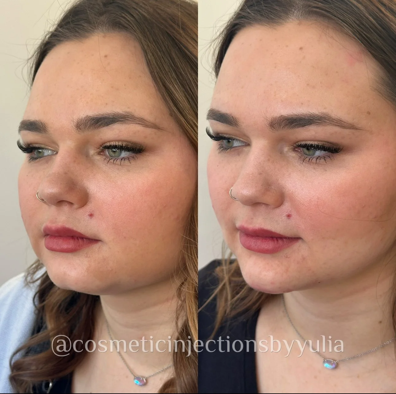Chin filler to elongate the face and balance proportions