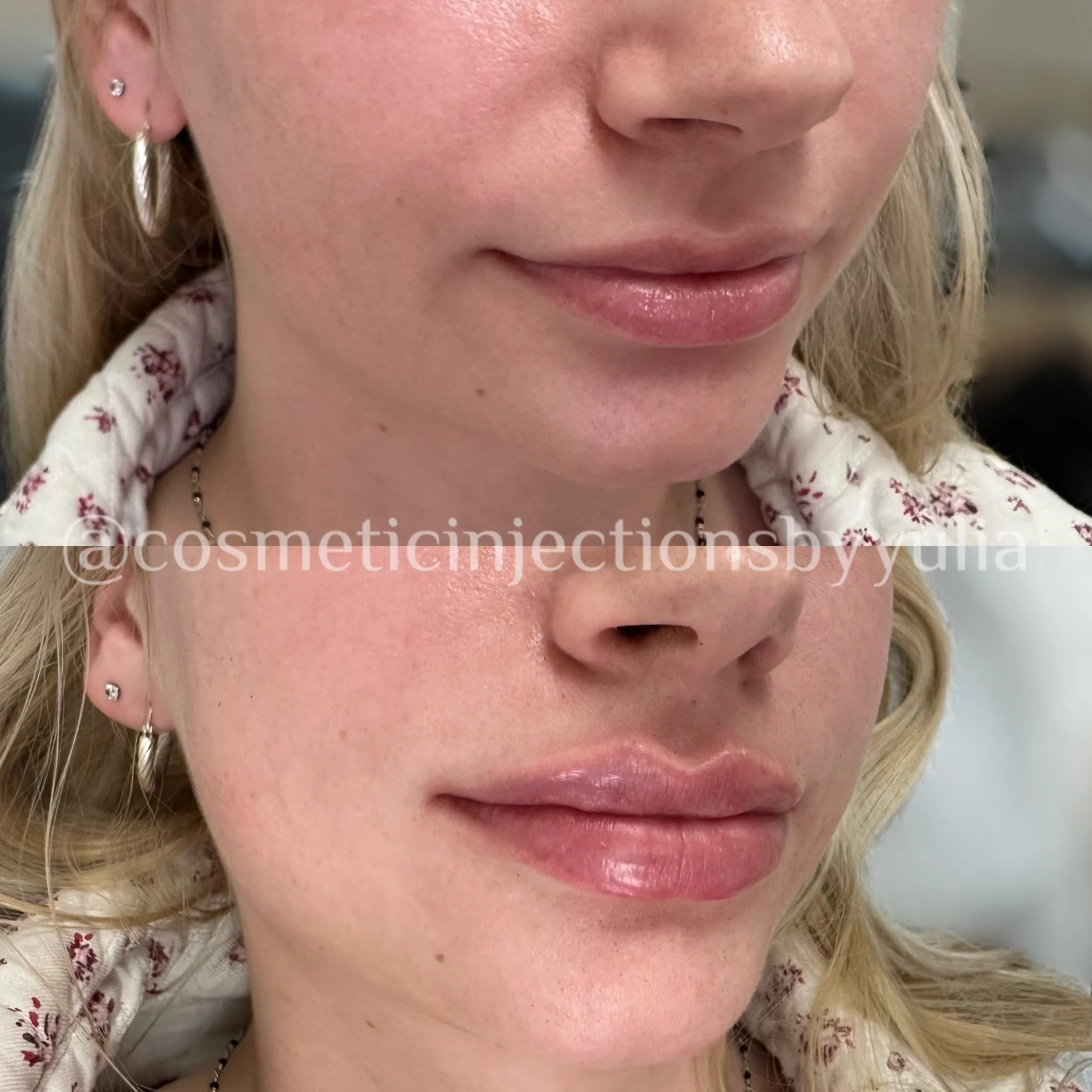 Immediately after treatment. Please note that there is swelling.