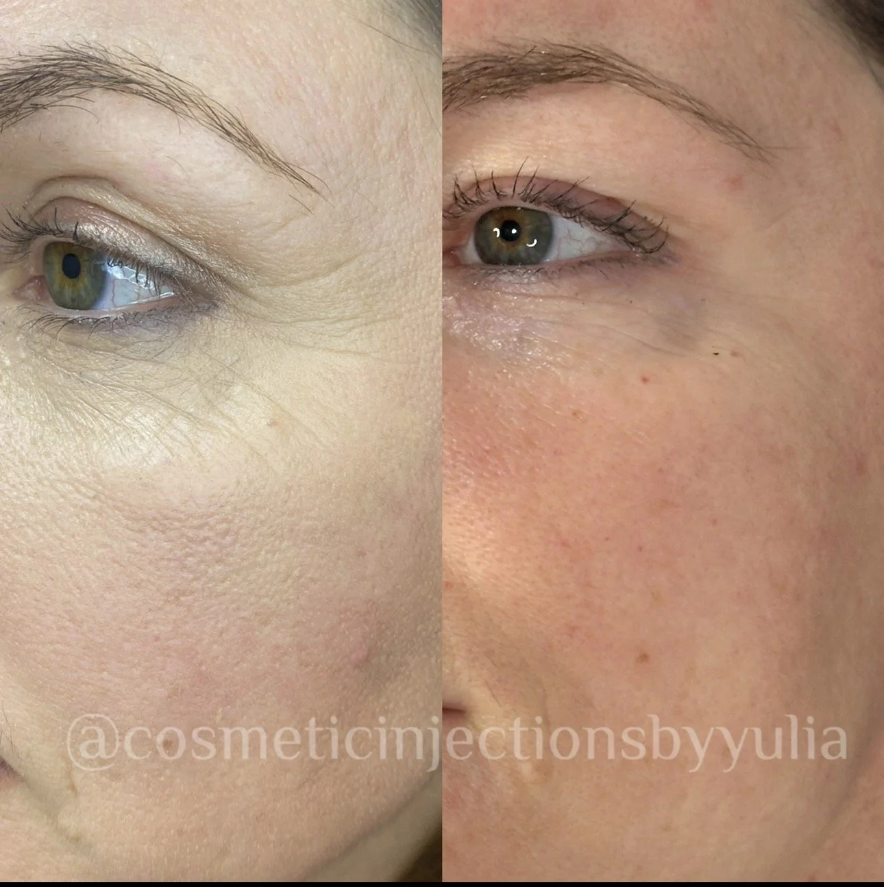 Immediatley after 1 PRX Treatment