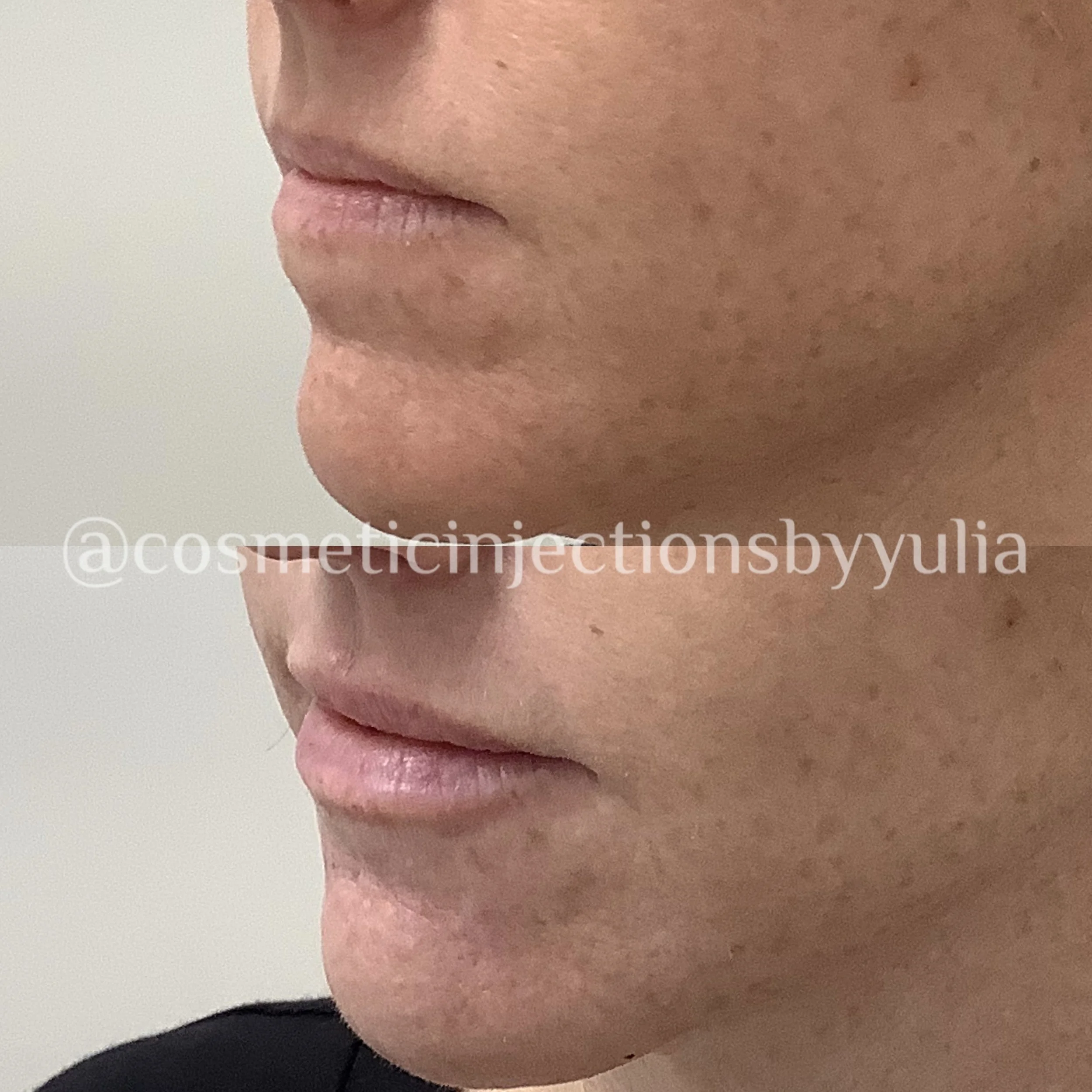 Chin and lip filler results