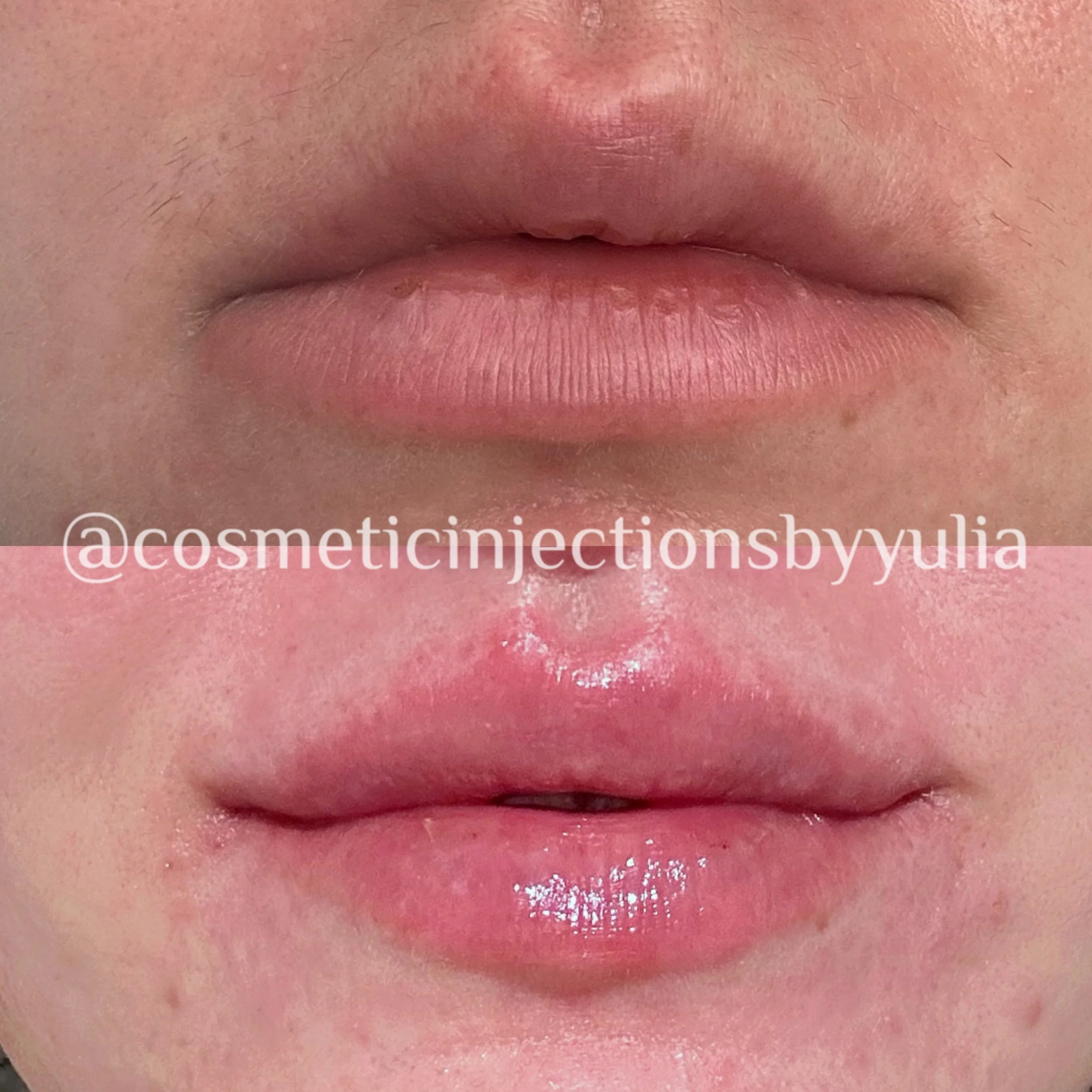 Filler to correct lip shape.