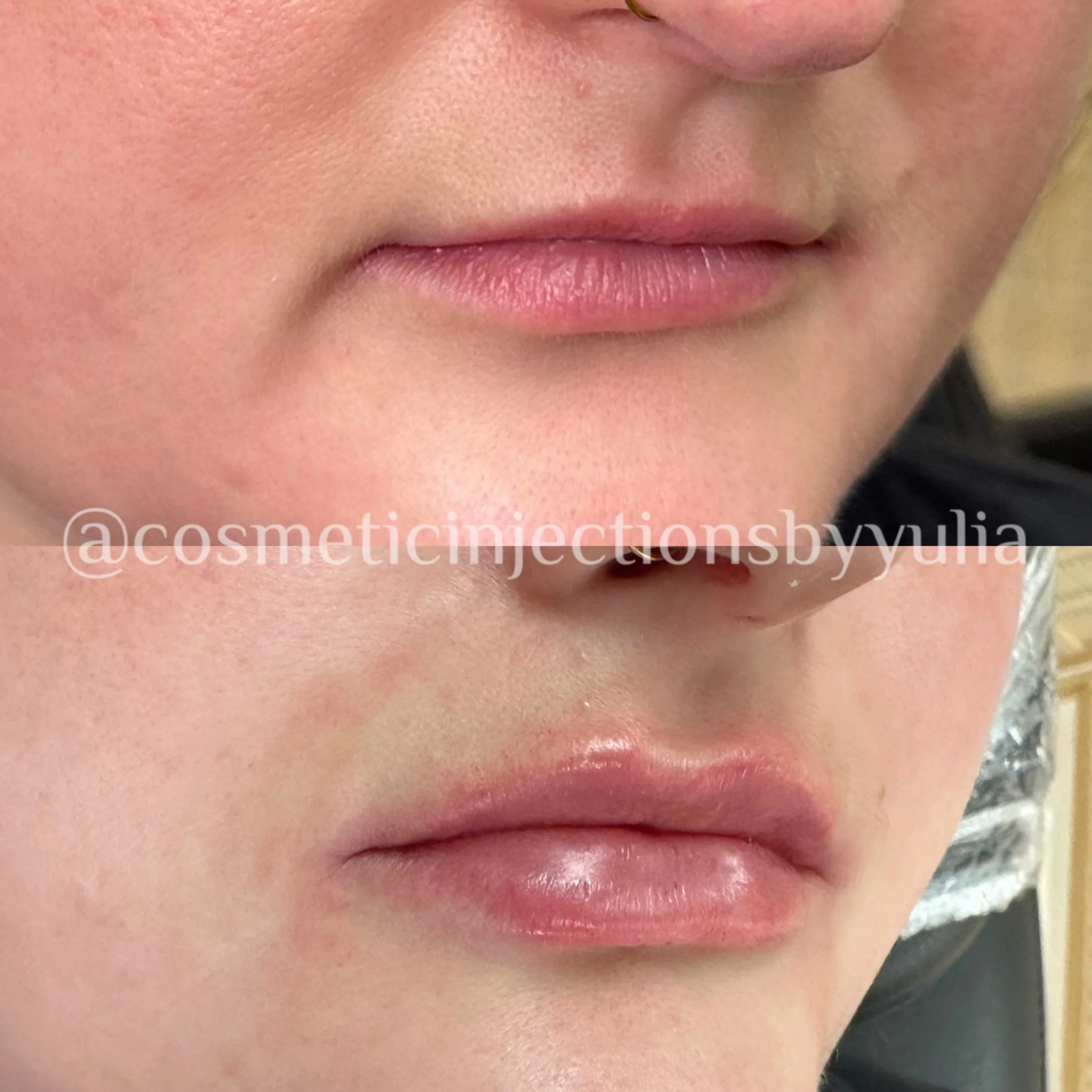 After several filler sessions.