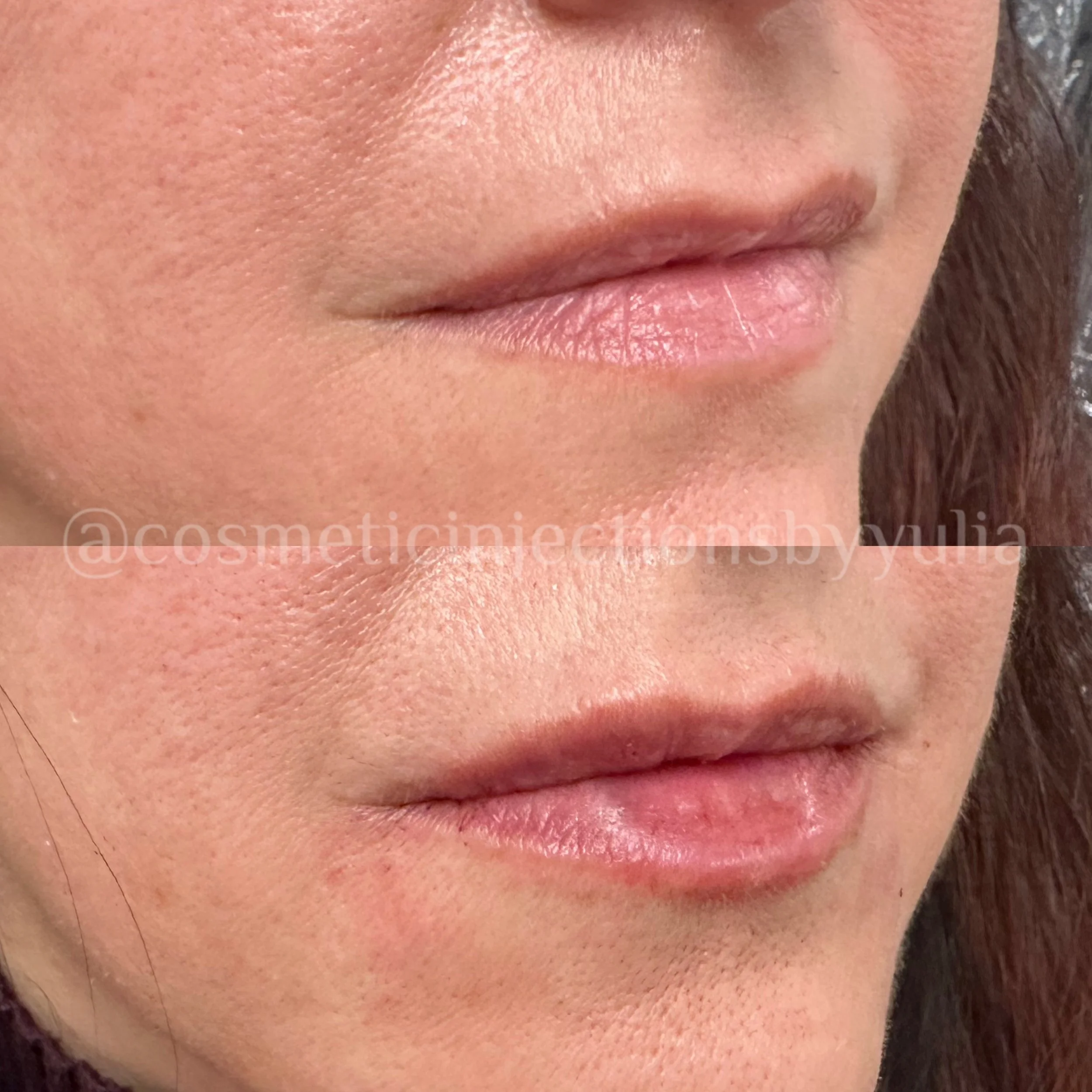 Filler for lip hydration.