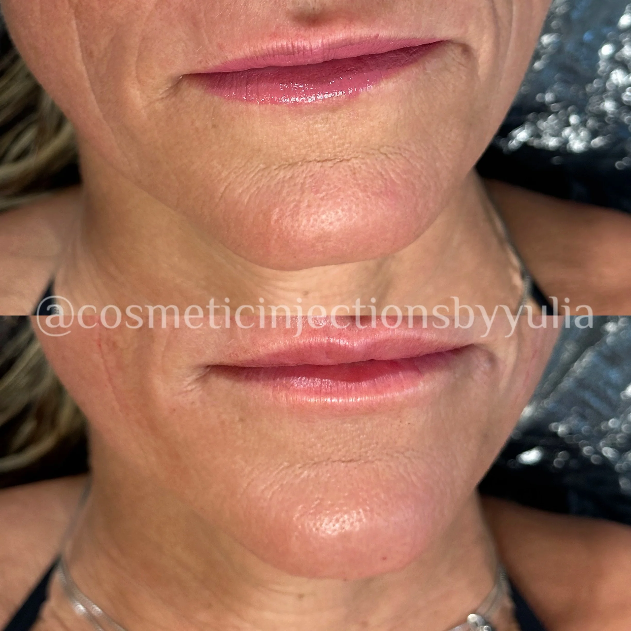 Chin filler results
