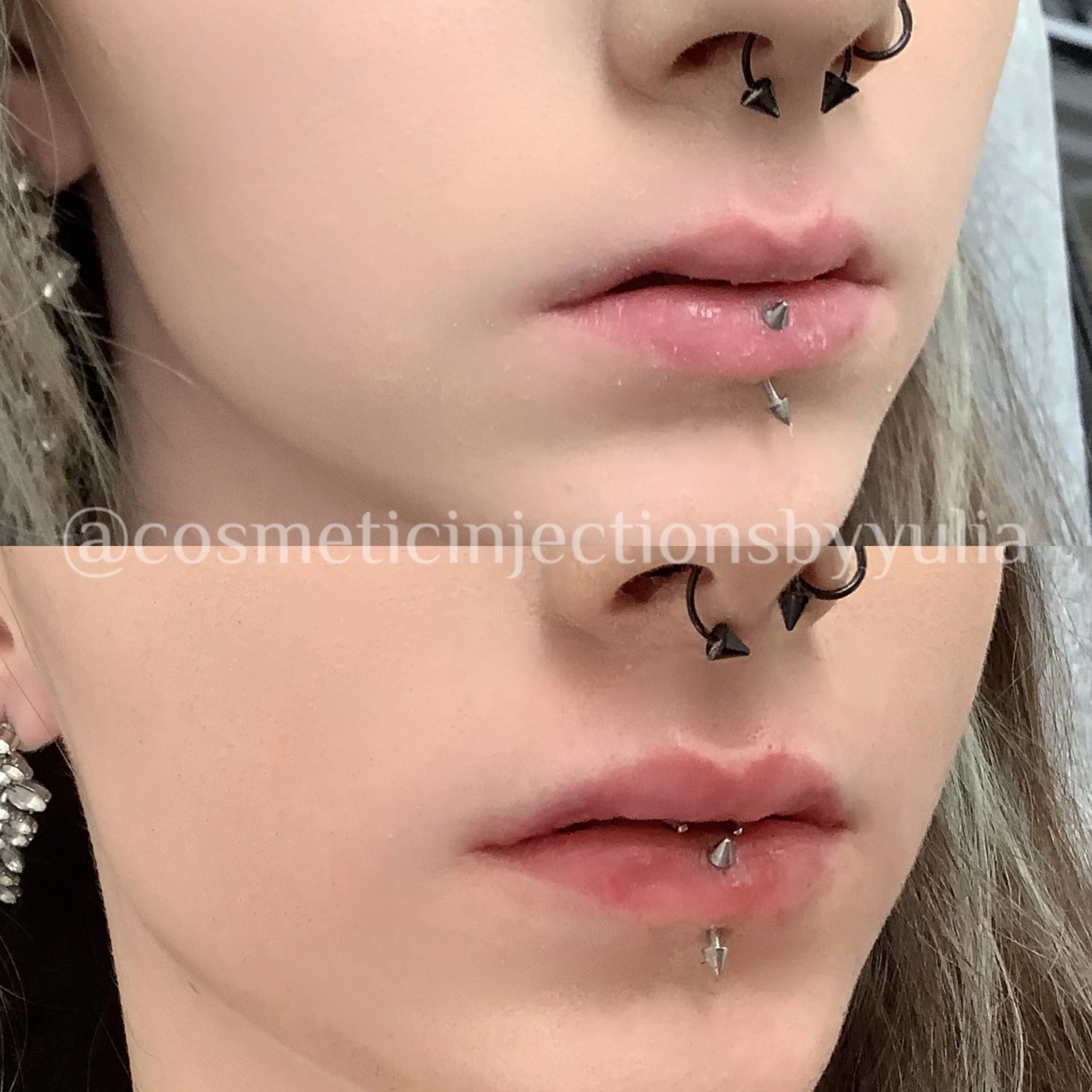 Filler to correct lip shape.