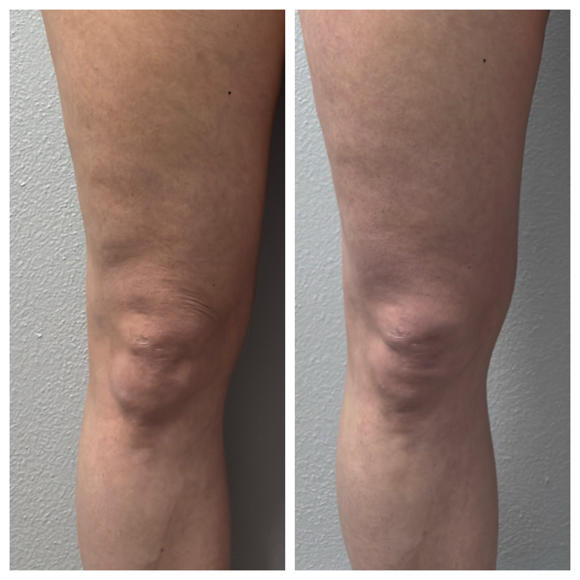 Loose Skin After Weight Loss?