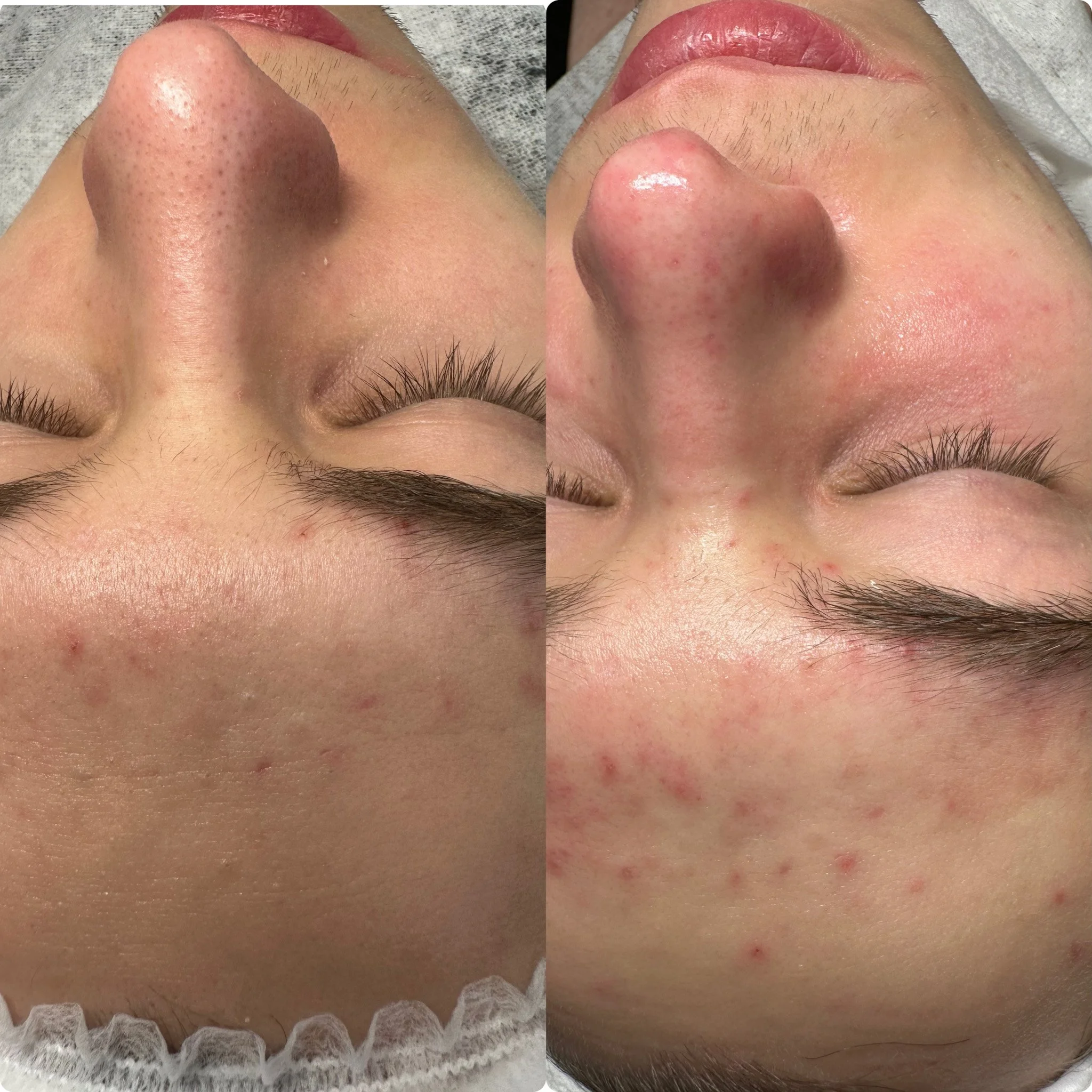 Before and after acne treatment showing reduced inflammation and clearer skin, professional facial care in Seattle