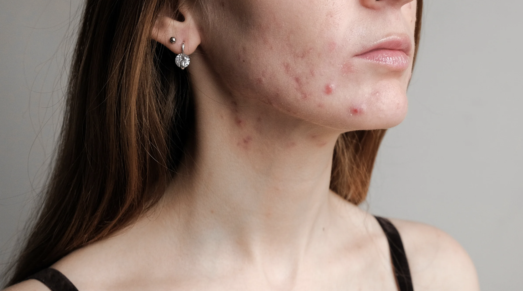 When Anxiety, Cystic Acne &amp; Painful Periods Aren’t “Fixed” by Birth Control: Why We Start With Your Gut