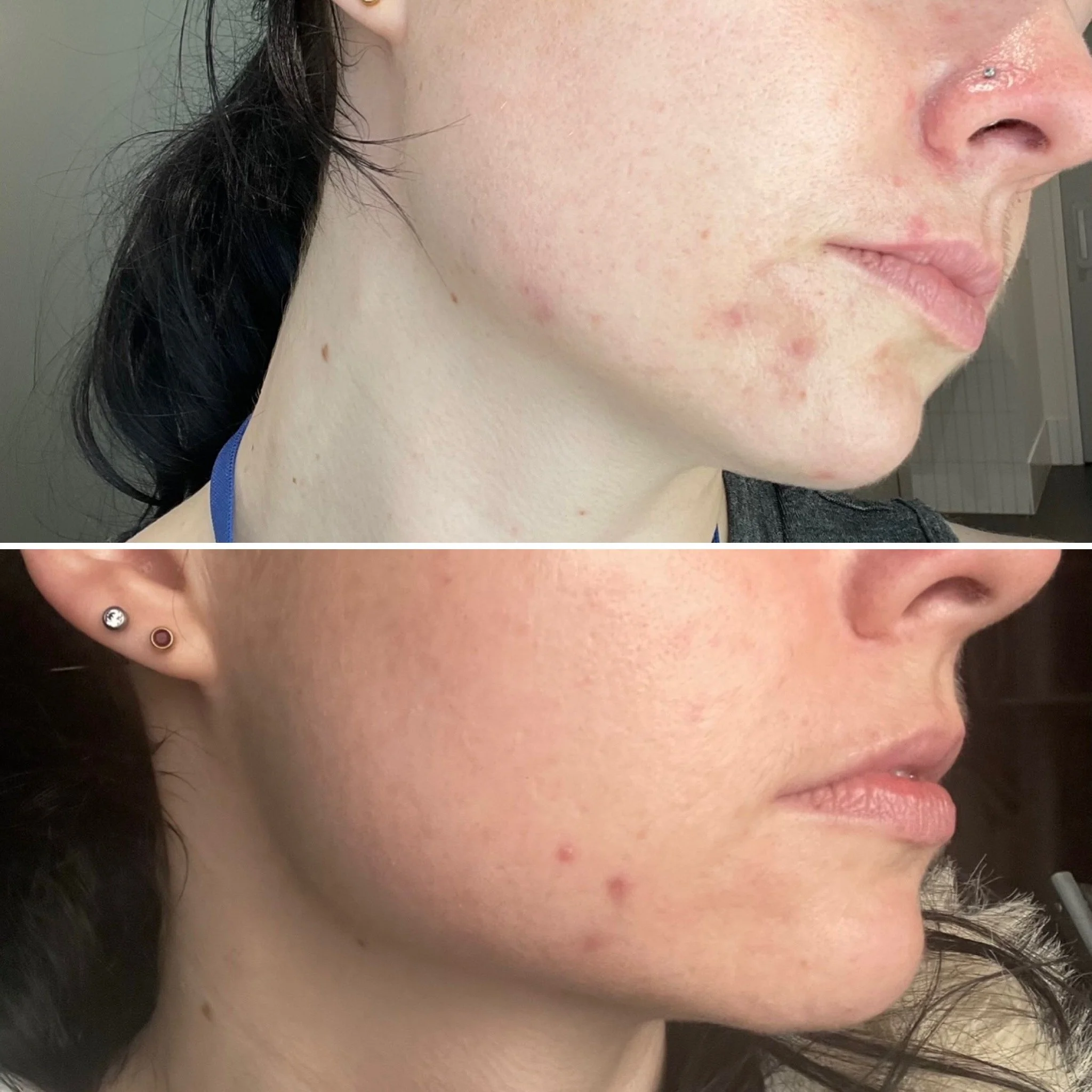 Acne Adelaide