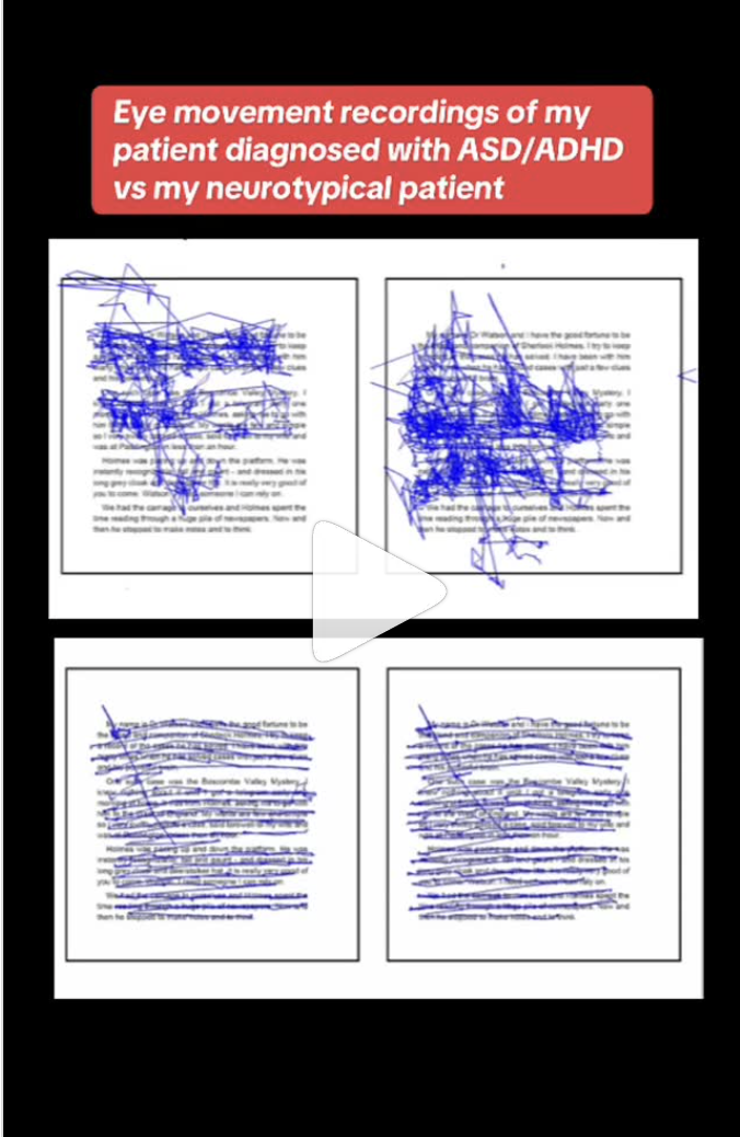 An image of 4 books with text written on them. Blue lines track eye movements across the page. Top 2 show a patient with ASD/ADHD, the bottom