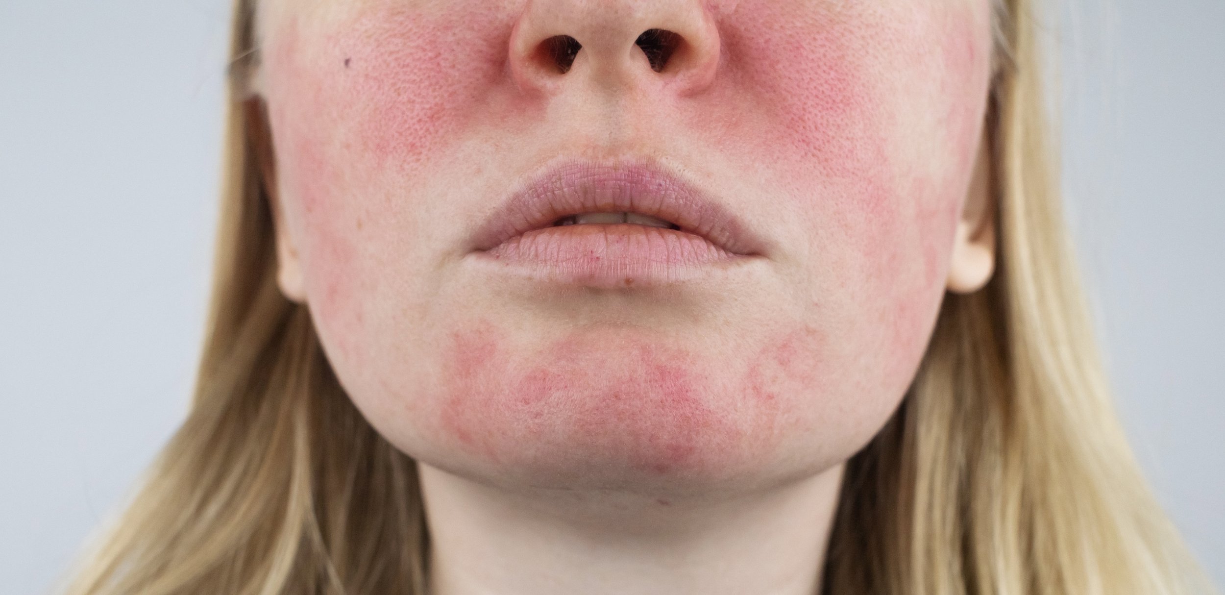 Rosacea face. The girl suffers from redness on her cheeks. Couperosis of the skin. Redness and capillary mesh are visible on the face. Treatment and removal. Vascular surgery and dermatology