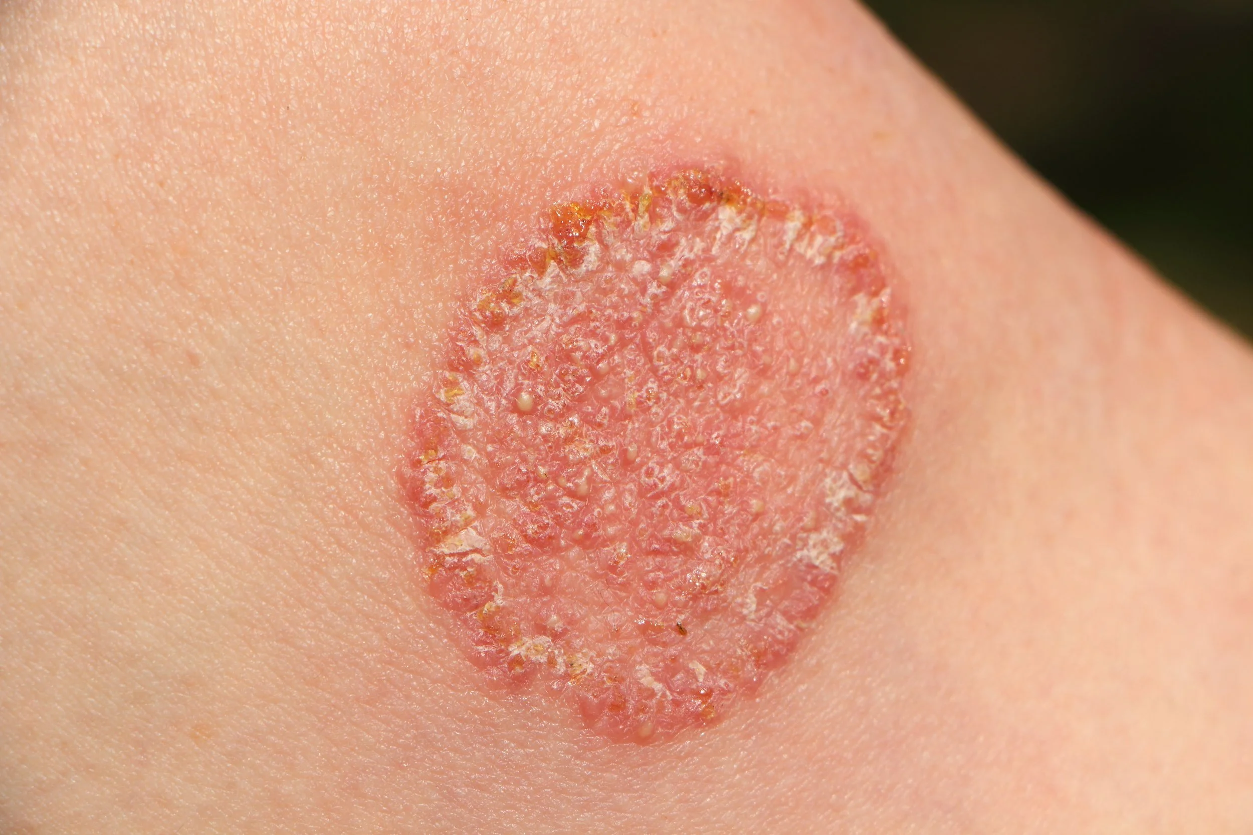 fungal infection on skin