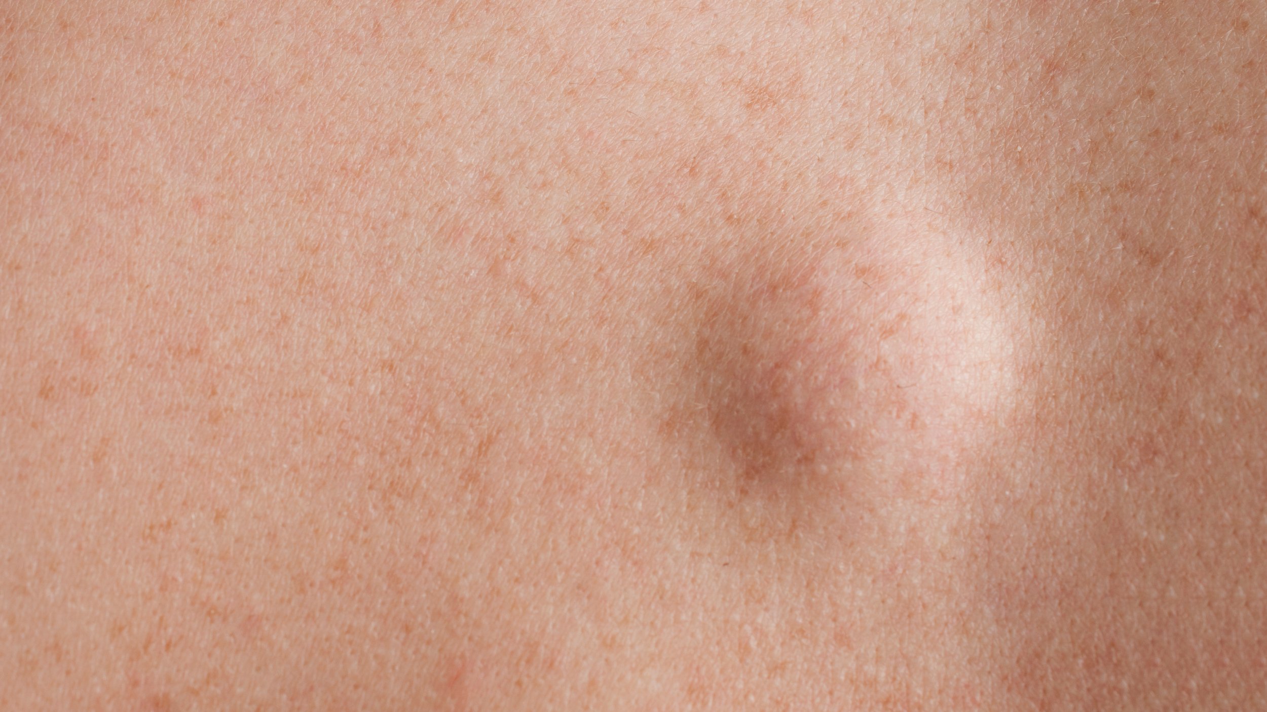 Round lipoma close up shot on the back of a Caucasian man