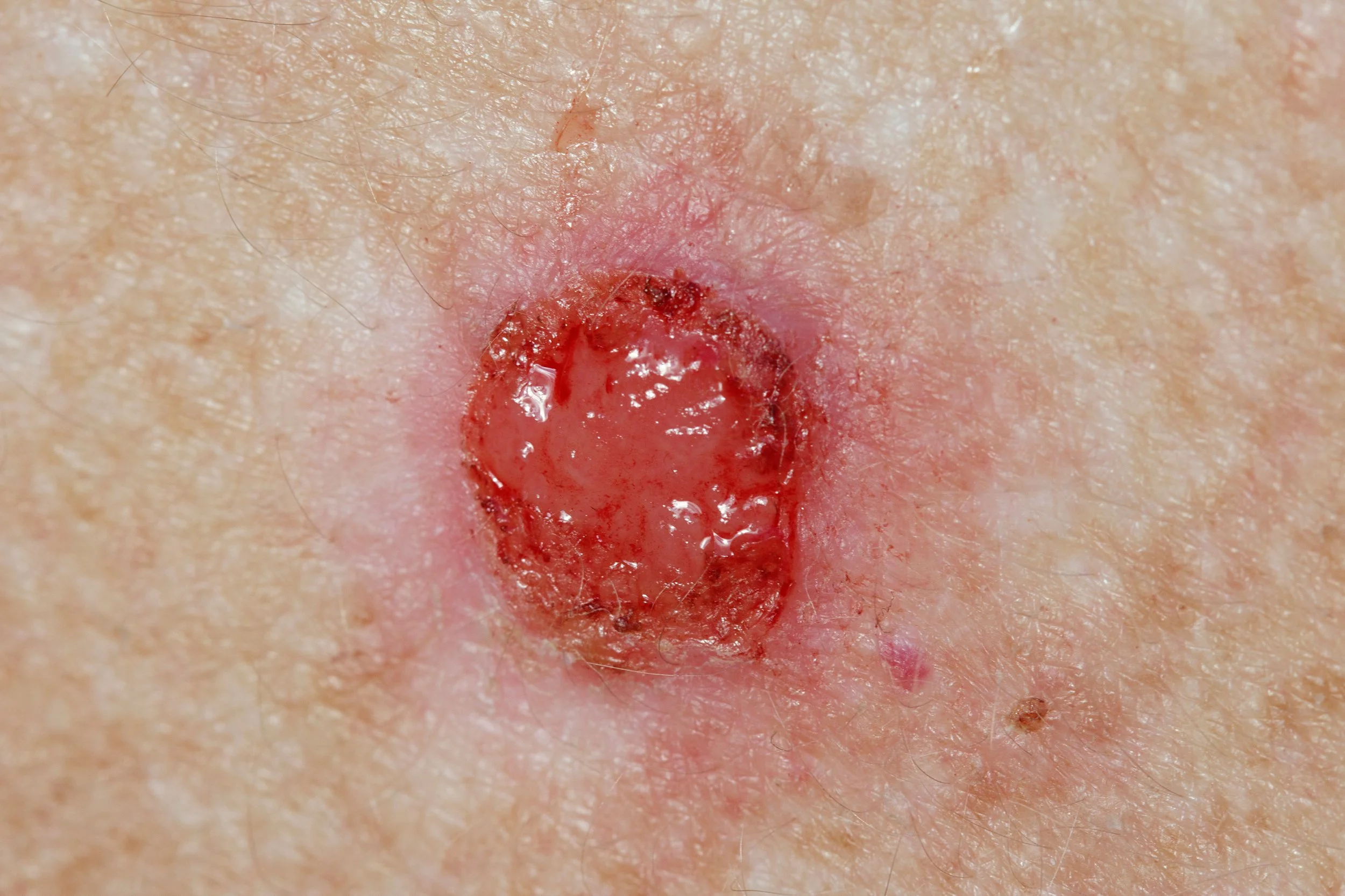 Basal Cell pre-treatment - sore open wound with constant weeping and bleeding.