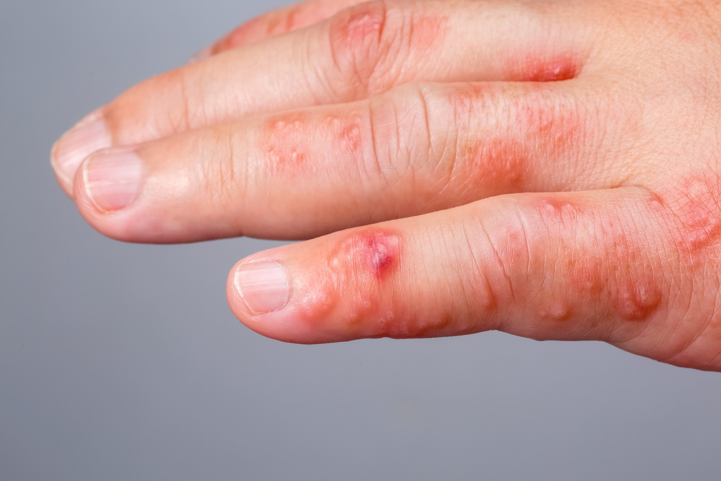 Shingles, Zoster or Herpes Zoster symptoms on arm