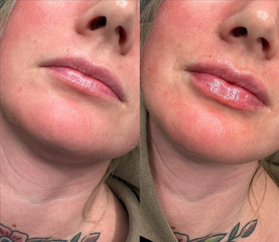 👄 👄👄

.
. 
.
. 

#nurseinjector #fillers #beauty #lips #lipfiller #yegnurseinjector #dermalfiller #stonyplain #stonyplainbusiness #sprucegrove #yegnurseinjector #aesthetic #revanesselips #cosmeticinjections
