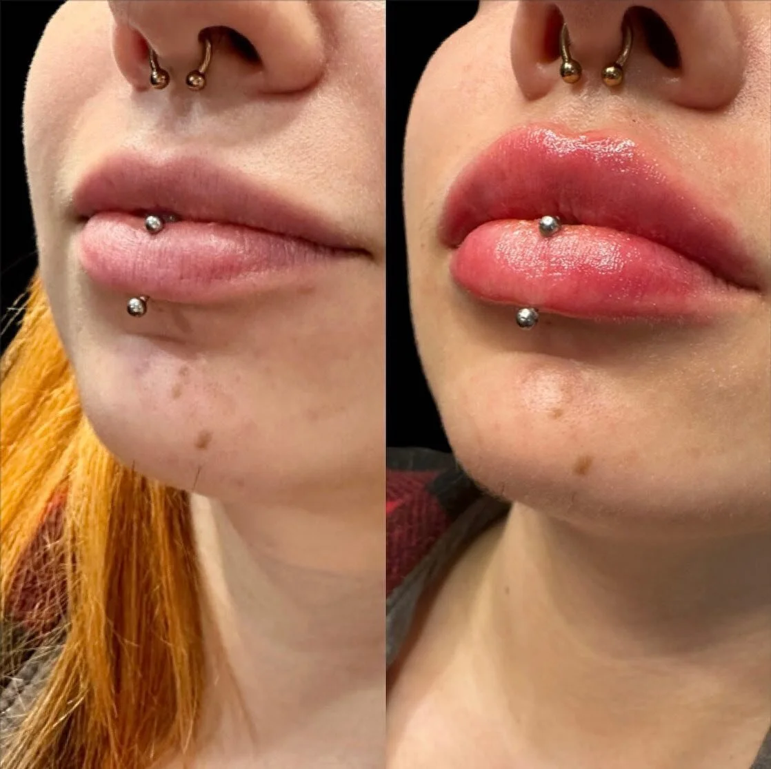 Obsessed 🔥🔥🔥

1/2 Syringe
Product: Revanesse Kiss 
.
. 
.
. 

#nurseinjector #fillers #beauty #lips #lipfiller #yegnurseinjector #dermalfiller #stonyplain #stonyplainbusiness #sprucegrove #yegnurseinjector #aesthetic #revanesselips #cosmeticinject