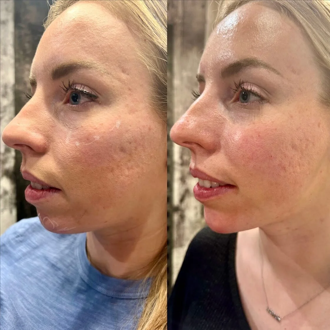 CHIN projection &amp; CHEEK support to provide balance of facial features. 
 
And look at that jaw line!!! I&rsquo;m obsessed. 
.
. 
.
. 

#nurseinjector #fillers #beauty #lips #lipfiller #yegnurseinjector #dermalfiller #stonyplain #stonyplainbusines