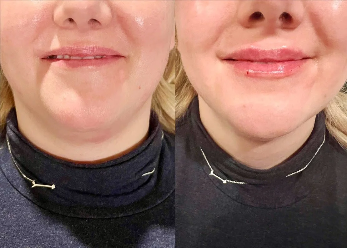 👄 👄👄

Product: 1/2 Syringe Revanesse Ultra
.
. 
.
. 

#yeg #nurseinjector #botox #fillers #beauty #lips #lipfiller #yyc #yegnurseinjector #yegliving #dermalfiller #stonyplain #stonyplainbusiness #dysport #sprucegrove #yegnurseinjector #aesthetic #