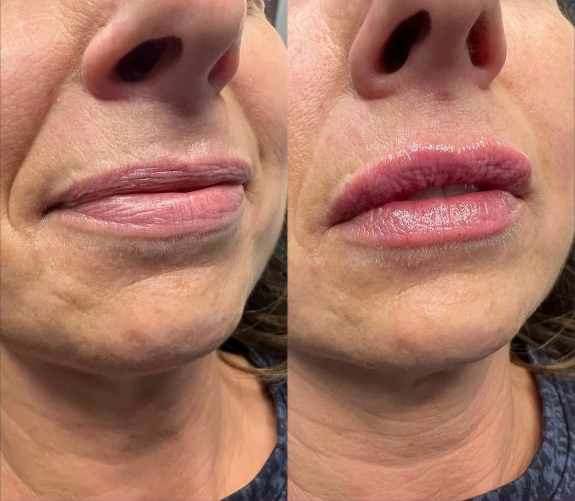 Rejuvenated LIPS 👄 

Product: Revanesse Kiss
.
. 
.
. 

#yyc #yeg #nurseinjector #botox #fillers #beauty #lips #lipfiller #yegnurseinjector #yegliving #dermalfiller #stonyplain #stonyplainbusiness #dysport #sprucegrove #yegnurseinjector #aesthetic #