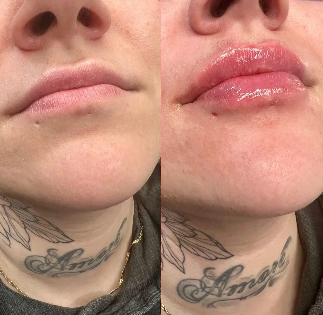 OBSESSED with these LIPS 👄 

Product: 1/2 Syringe Revanesse Kiss
.
. 
.
. 

#yyc #yeg #nurseinjector #botox #fillers #beauty #lips #lipfiller #yegnurseinjector #yegliving #dermalfiller #stonyplain #stonyplainbusiness #dysport #sprucegrove #yegnursei