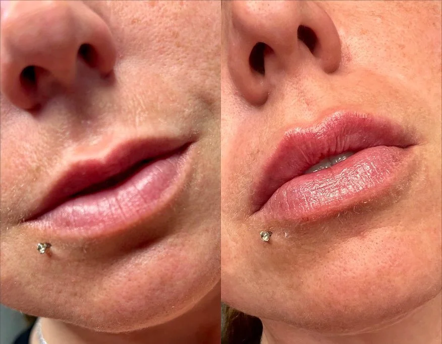LIPS 👄 

Product: 1/2 Syringe Revanesse Ultra
.
. 
.
. 

#yyc #yeg #nurseinjector #botox #fillers #beauty #lips #lipfiller #yegnurseinjector #yegliving #dermalfiller #stonyplain #stonyplainbusiness #dysport #sprucegrove #yegnurseinjector #aesthetic 