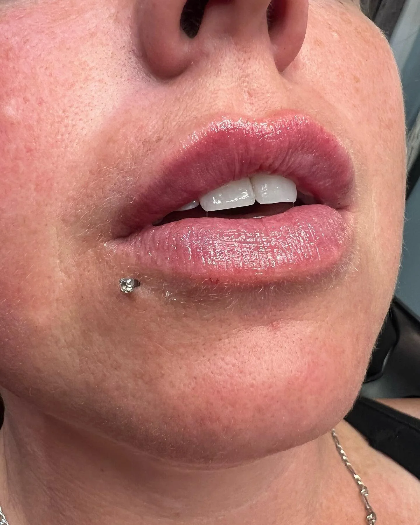 LIPS 👄 

Love, love, love these results! 

Product: 1/2 Syringe Revanesse Ultra
.
. 
.
. 

#yyc #yeg #nurseinjector #botox #fillers #beauty #lips #lipfiller #yegnurseinjector #yegliving #dermalfiller #stonyplain #stonyplainbusiness #dysport #spruceg