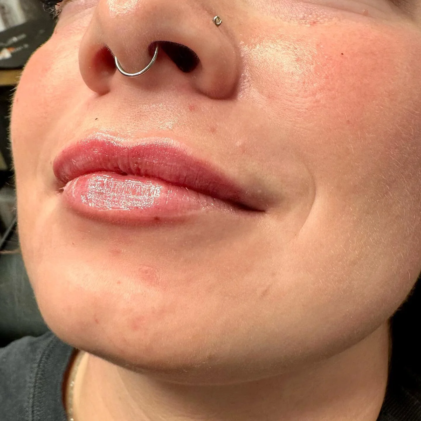 LIPS 👄 ❤️&zwj;🔥👄

1/2 Syringe
Product: Revanesse Ultra
.
. 
.
. 

#nurseinjector #fillers #beauty #lips #lipfiller #yegnurseinjector #dermalfiller #stonyplain #stonyplainbusiness #sprucegrove #yegnurseinjector #aesthetic #revanesselips #cosmeticin