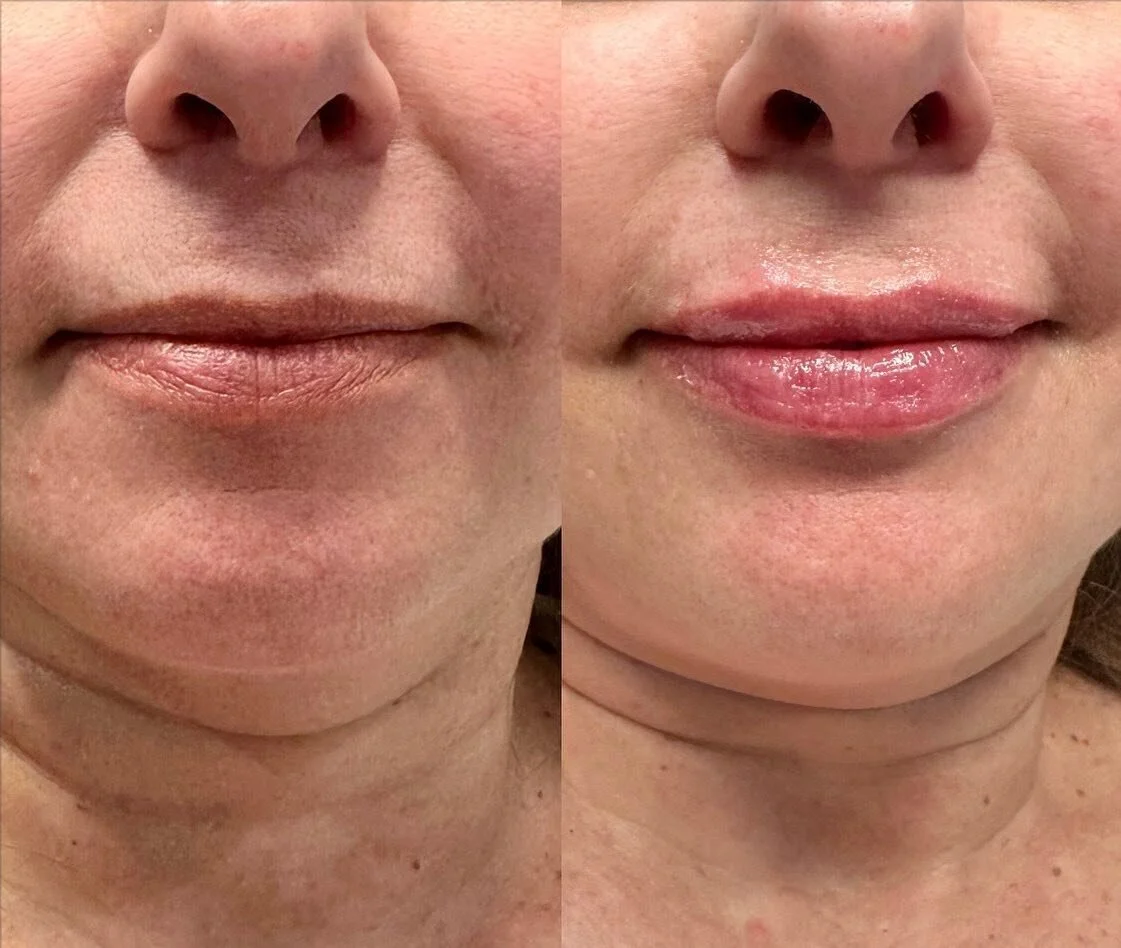 LIPS 👄

volume replenished.

1/2 Syringe
Product: Revanesse Kiss
.
. 
.
. 

#nurseinjector #fillers #beauty #lips #lipfiller #yegnurseinjector #dermalfiller #stonyplain #stonyplainbusiness #sprucegrove #yegnurseinjector #aesthetic #revanesselips #co