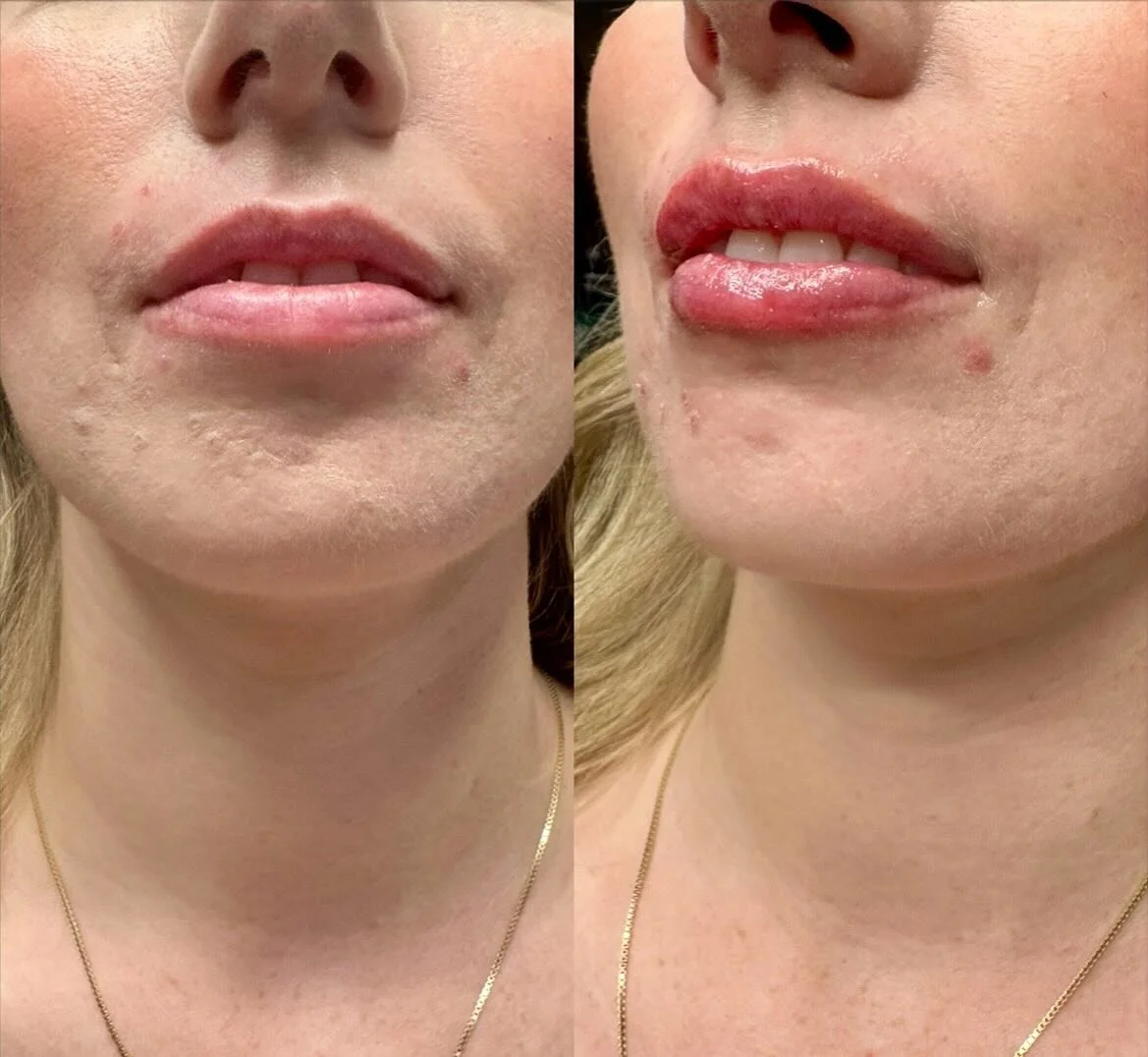 LIPS 👄 
1/2 Syringe
Product: Revanesse Kiss
.
. 
.
. 

#nurseinjector #fillers #beauty #lips #lipfiller #yegnurseinjector #dermalfiller #stonyplain #stonyplainbusiness #sprucegrove #yegnurseinjector #aesthetic #revanesselips #cosmeticinjections