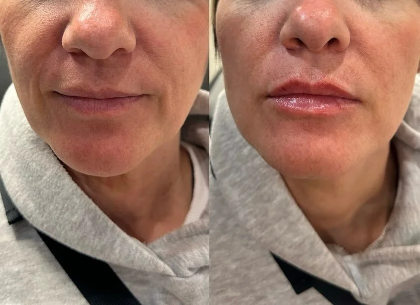 LIPS 👄 

Volume &amp; symmetry. 

Product: Revanesse Kiss
.
. 
.
. 

#nurseinjector #fillers #beauty #lips #lipfiller #yegnurseinjector #dermalfiller #stonyplain #stonyplainbusiness #sprucegrove #yegnurseinjector #aesthetic #revanesselips #cosmetici
