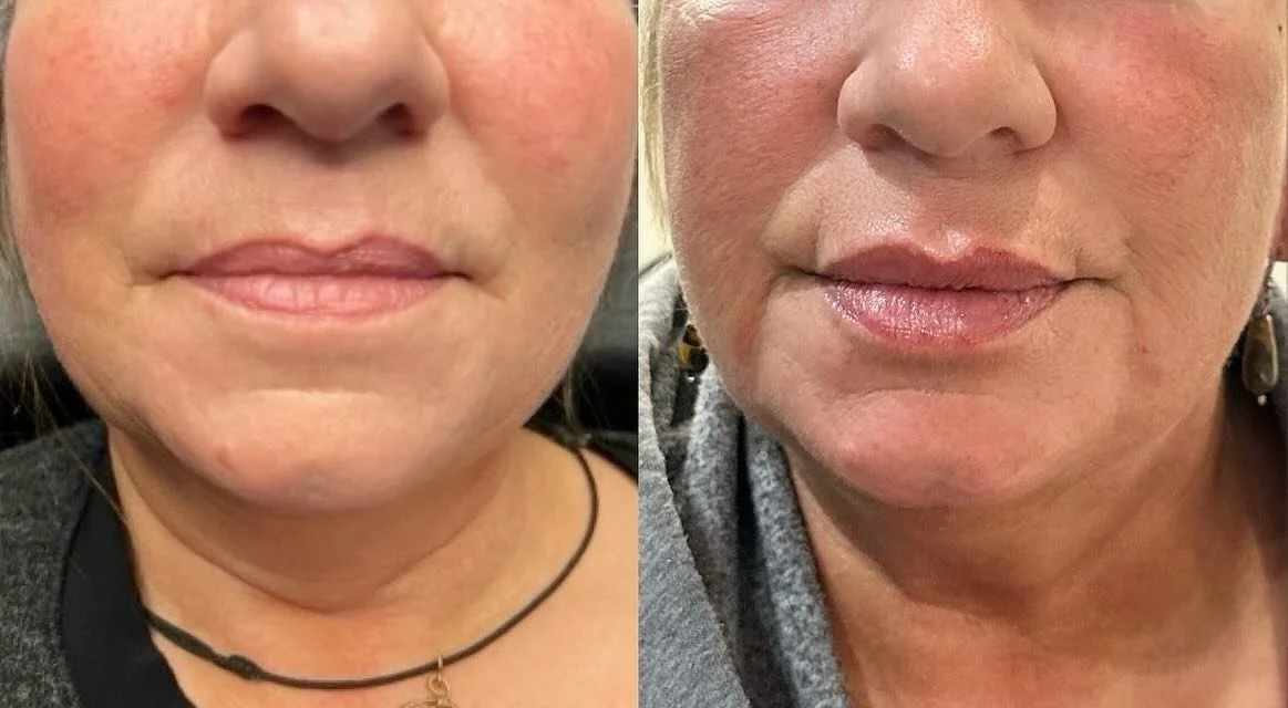 LIPS 👄 

Volume &amp; symmetry 

Product: Revanesse Ultra
.
. 
.
. 

#nurseinjector #fillers #beauty #lips #lipfiller #yegnurseinjector #dermalfiller #stonyplain #stonyplainbusiness #sprucegrove #yegnurseinjector #aesthetic #revanesselips #cosmetici
