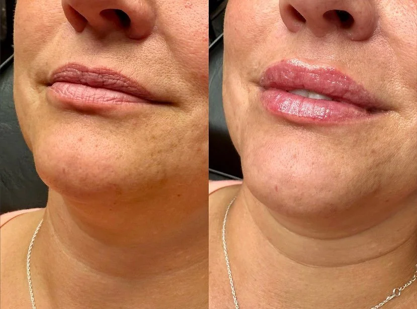 LIPS 👄

love, love, love these ❤️&zwj;🔥

1/2 Syringe
Product: Revanesse Ultra
.
. 
.
. 

#nurseinjector #fillers #beauty #lips #lipfiller #yegnurseinjector #dermalfiller #stonyplain #stonyplainbusiness #sprucegrove #yegnurseinjector #aesthetic #rev