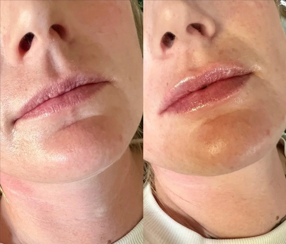 a little plump 👄 

Product: 1/2 Syringe Revanesse Ultra
.
. 
.
. 

#yyc #yeg #nurseinjector #botox #fillers #beauty #lips #lipfiller #yegnurseinjector #yegliving #dermalfiller #stonyplain #stonyplainbusiness #dysport #sprucegrove #yegnurseinjector #
