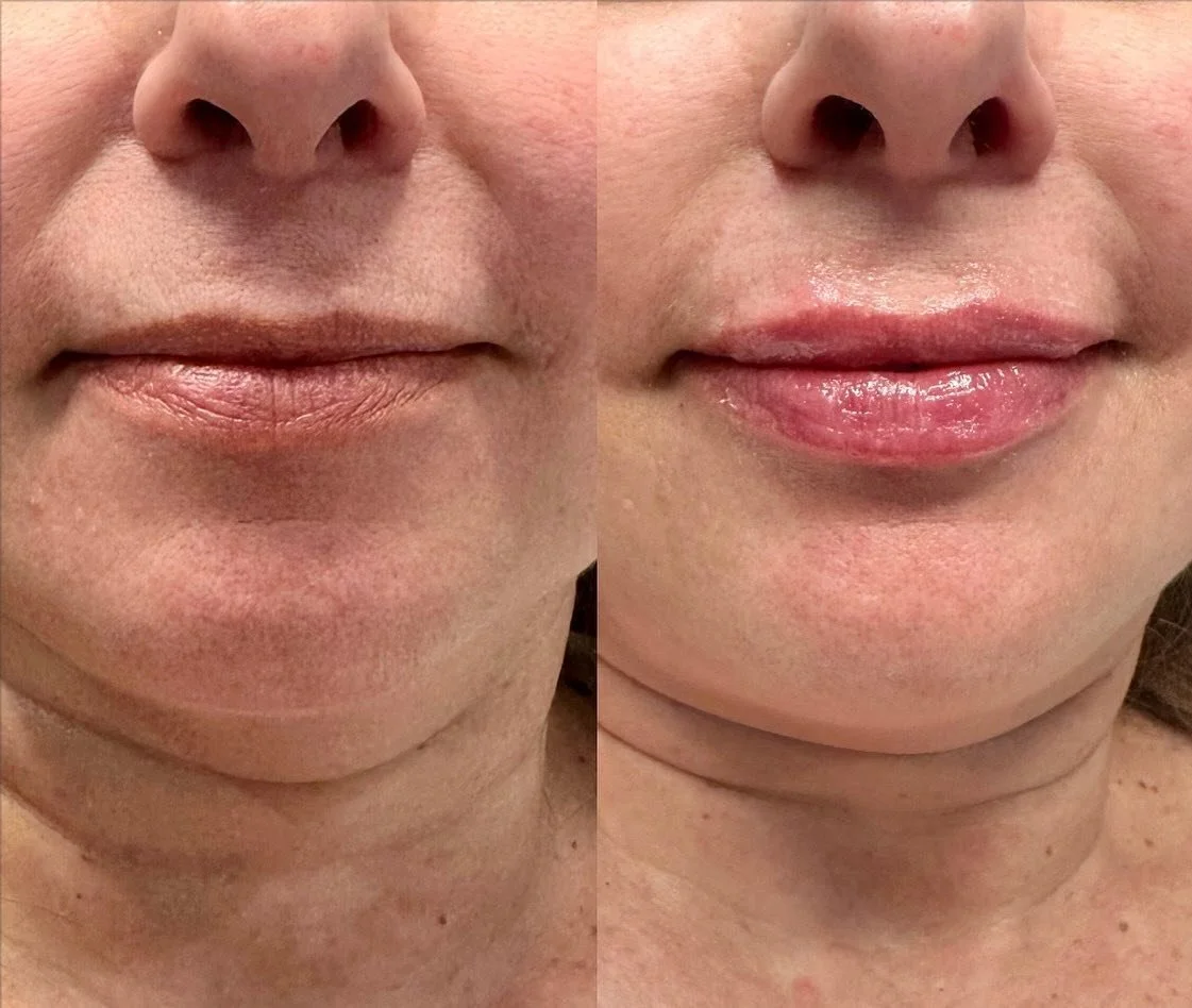 LIPS 👄

volume replenished.

1/2 Syringe
Product: Revanesse Kiss
.
. 
.
. 

#nurseinjector #fillers #beauty #lips #lipfiller #yegnurseinjector #dermalfiller #stonyplain #stonyplainbusiness #sprucegrove #yegnurseinjector #aesthetic #revanesselips #co