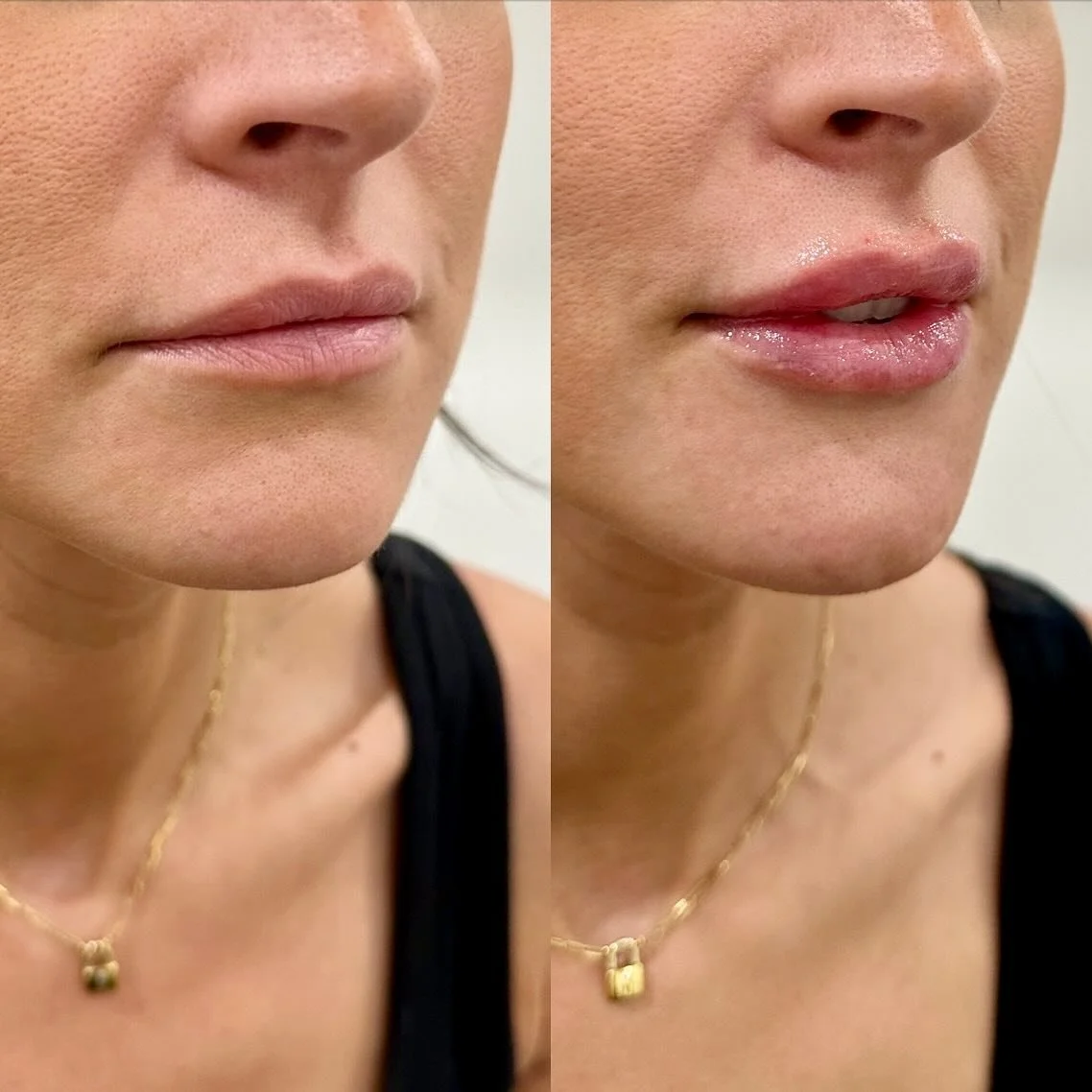 LIPS 👄 
.
.
. 
.
. 
.
.
.
.
.
#nurseinjector #fillers #beauty #lips #lipfiller #yegnurseinjector #dermalfiller #stonyplain #stonyplainbusiness #sprucegrove #yegnurseinjector #aesthetic #revanesselips #cosmeticinjections