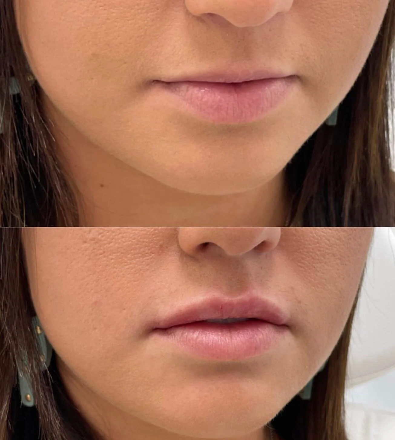 One of our favorite lip transformations of all time! It&rsquo;s amazing what a syringe of filler can do. 

How much is in a full syringe? 1mL which is:
- 1/5 of a teaspoon 
or
- the size of a blueberry!

Call us or send us a DM to book your lip fille