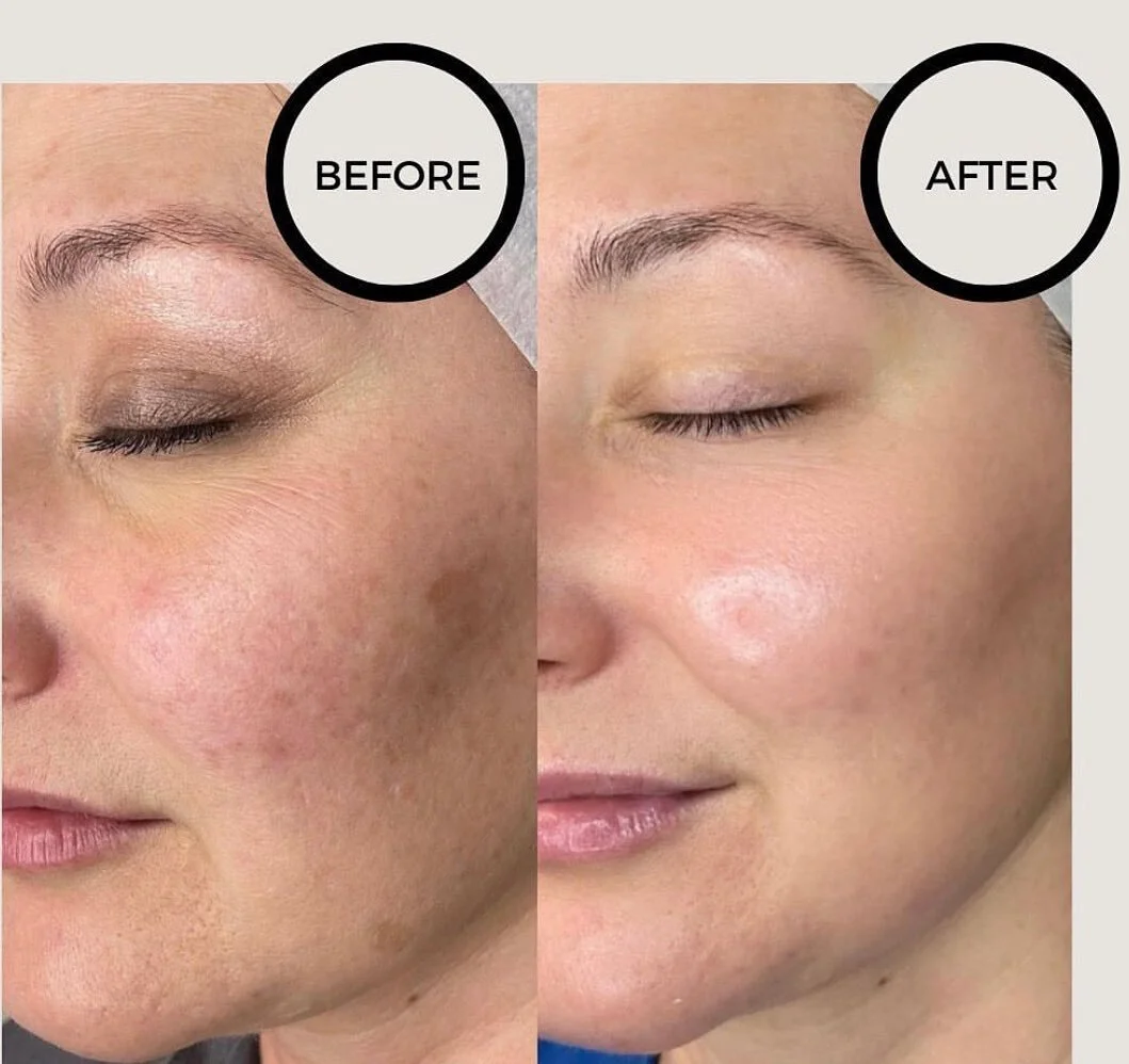 COMBO LASER TREATMENT - treat hyperpigmentation and build collagen!

These are results of BBL and Moxi laser treatments in combination with each other. Both treatments can be combined during the same session. Our combo laser treatment is on sale for 