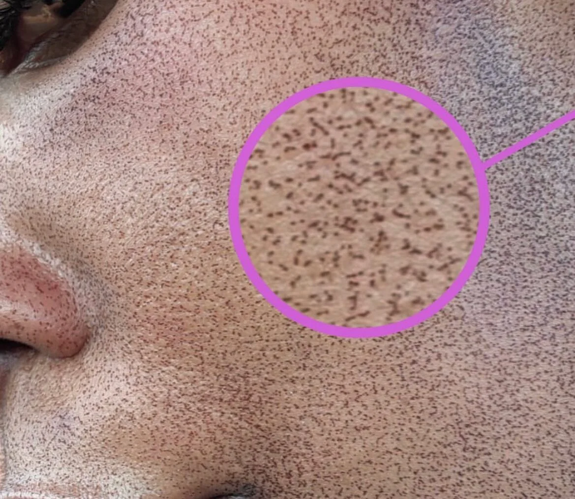MENDS are microscopic epidermal necrotic debris that come to the surface post MOXI treatment. These appear 2 or 3 days after the treatment and look like little coffee grounds. DO NOT pick at MENDS, they will slough off on their own. Under MENDS will 