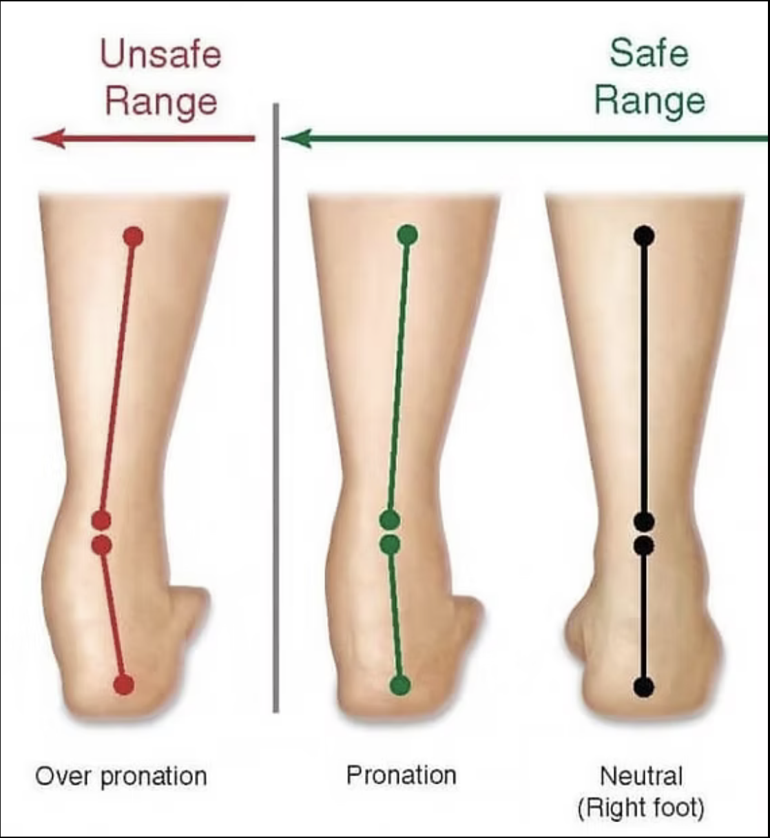 Understanding Overpronation: Why Your Feet Matter More Than You Think