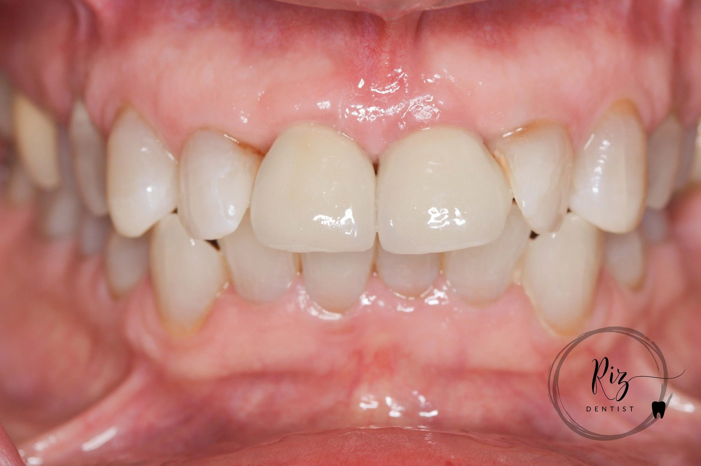 Missing front teeth can be challenging!